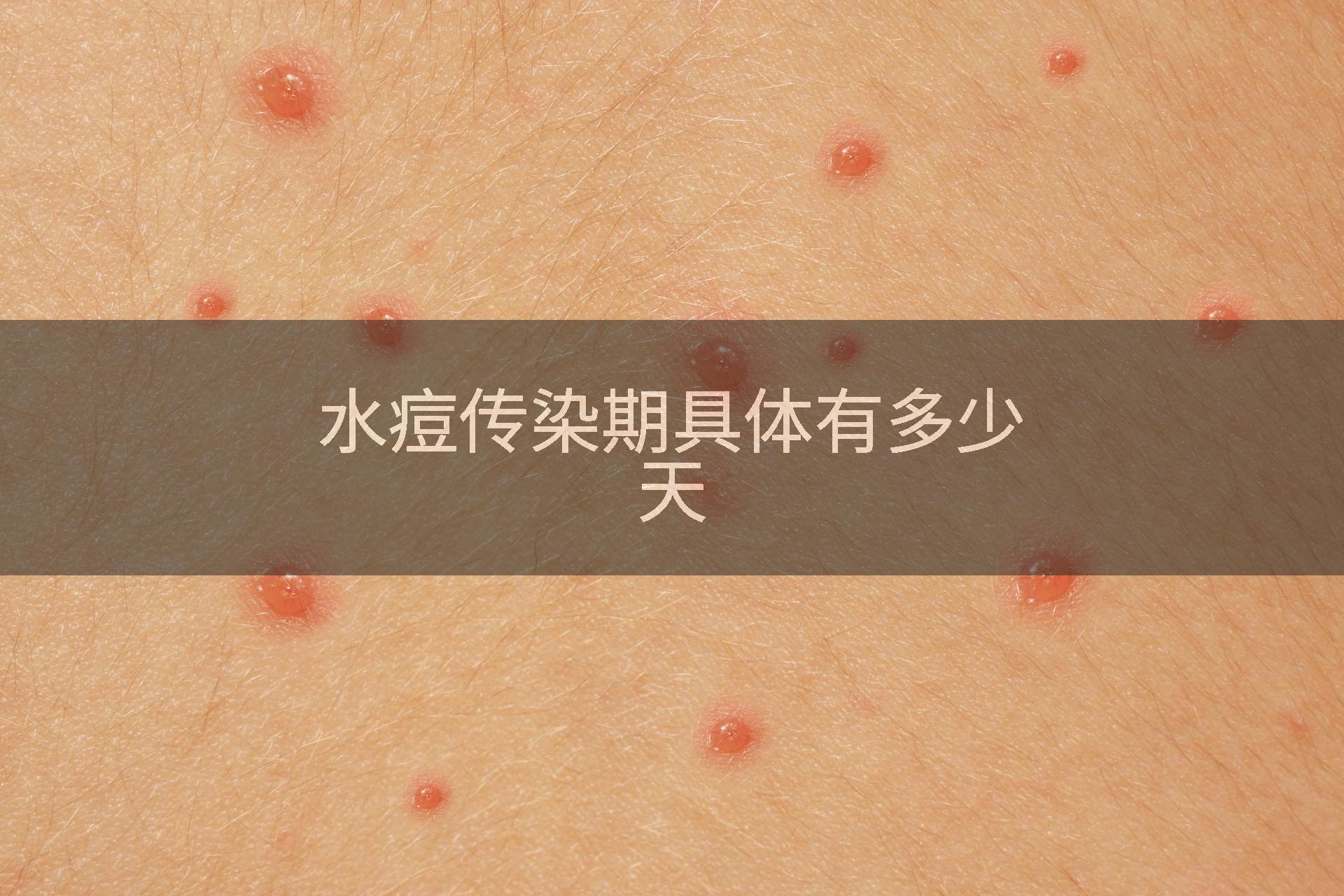水痘传染期具体有多少天