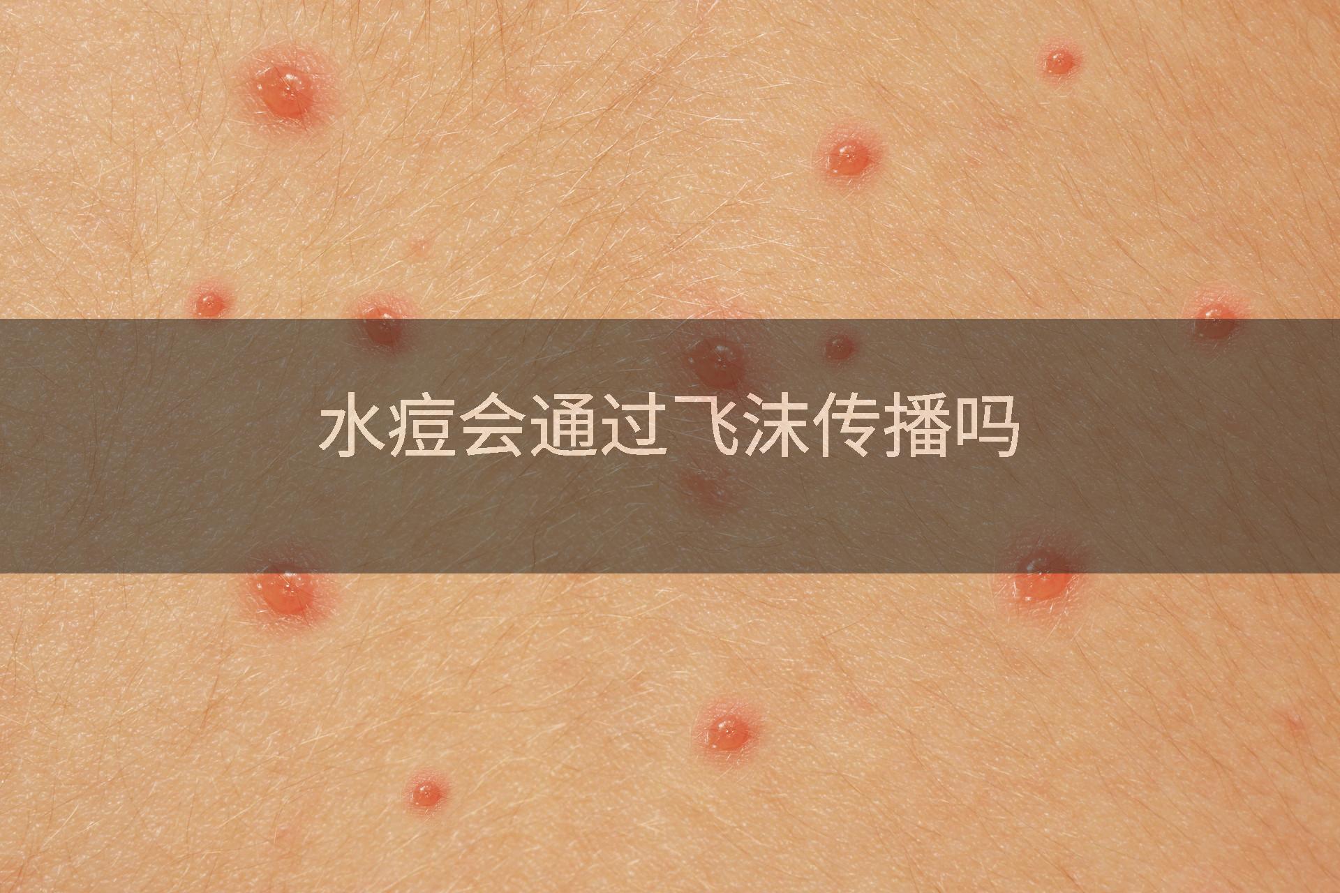 水痘会通过飞沫传播吗