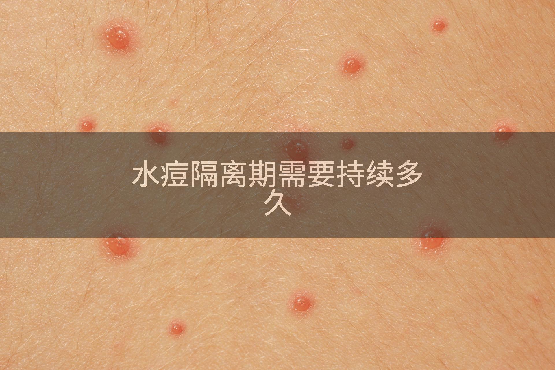 水痘隔离期需要持续多久