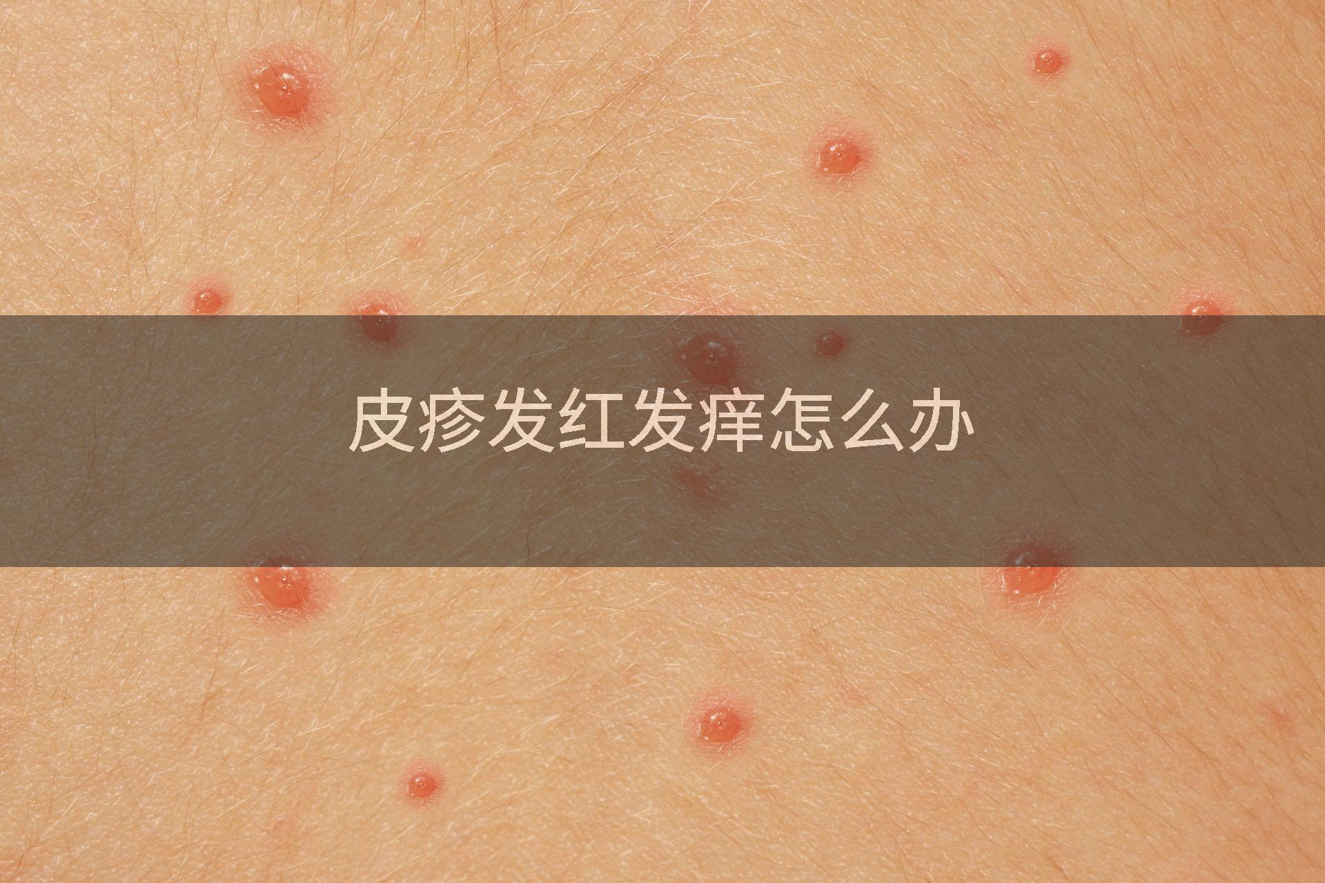 皮疹发红发痒怎么办
