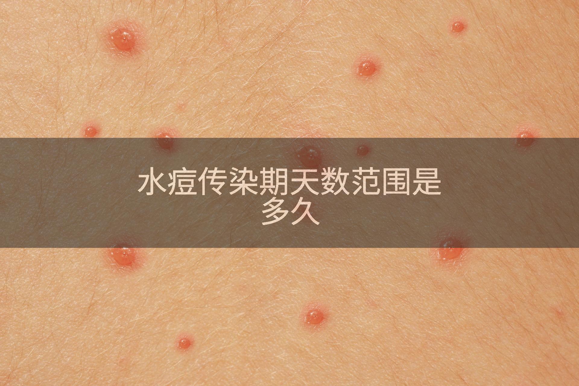 水痘传染期天数范围是多久