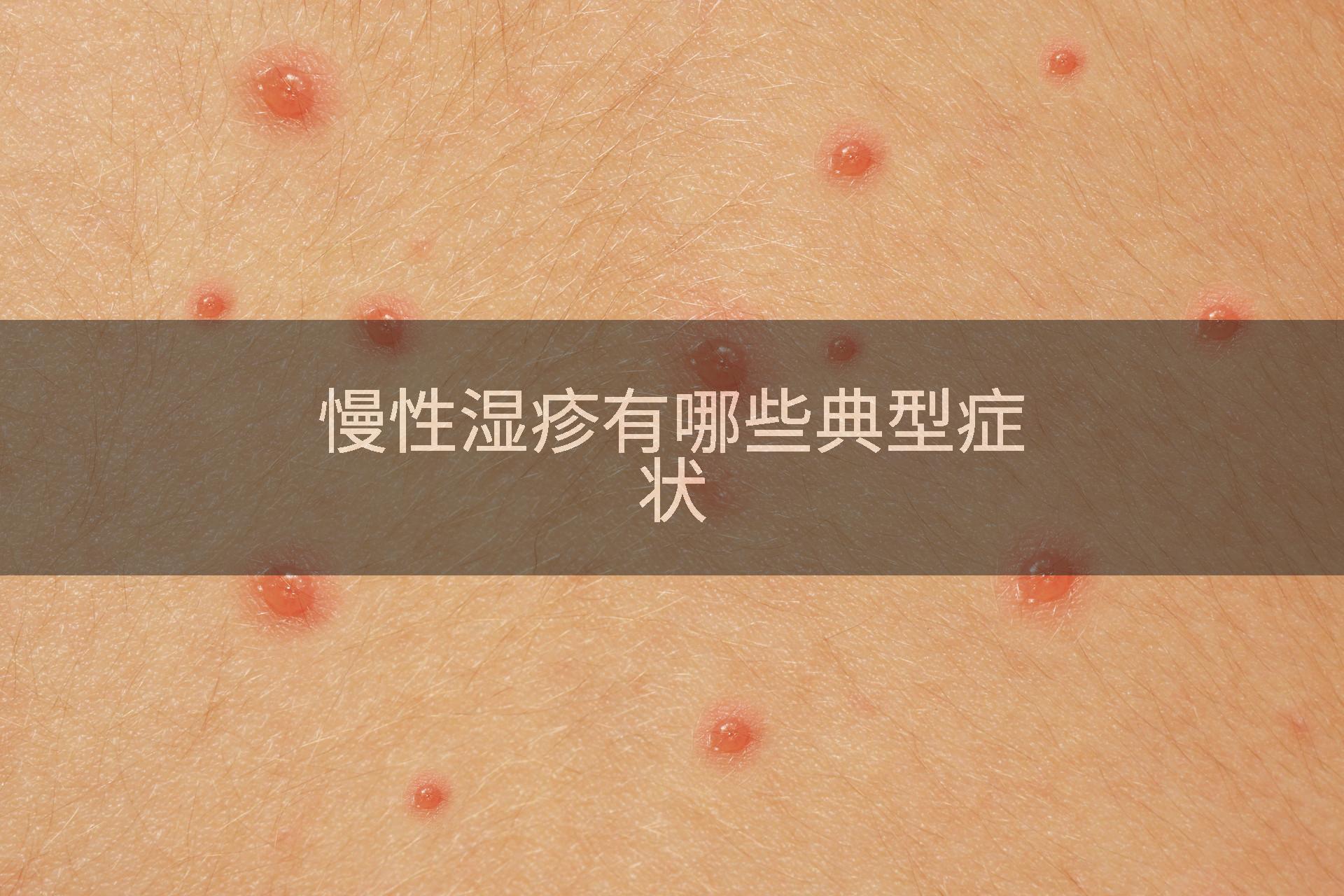 慢性湿疹有哪些典型症状