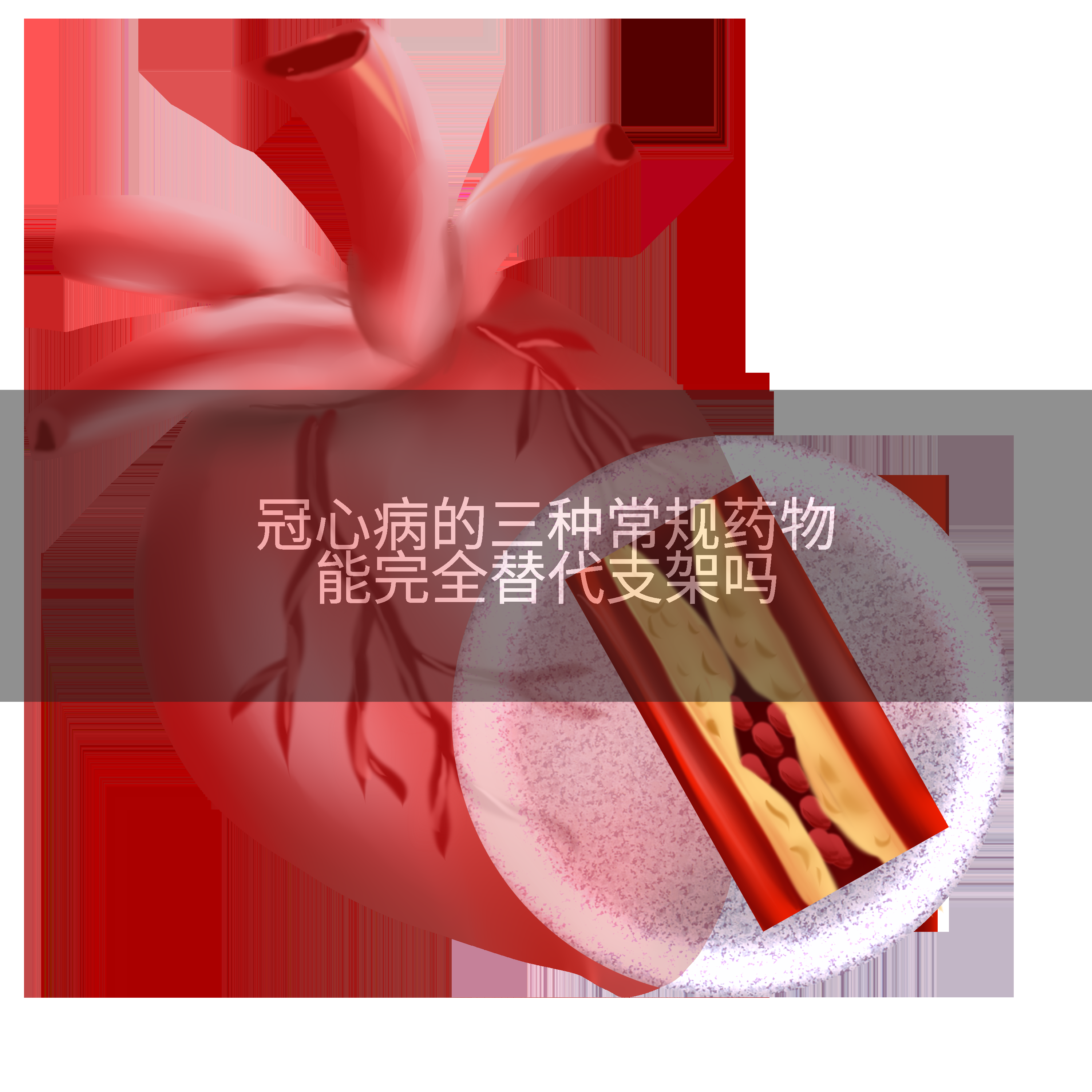 冠心病的三种常规药物能完全替代支架吗