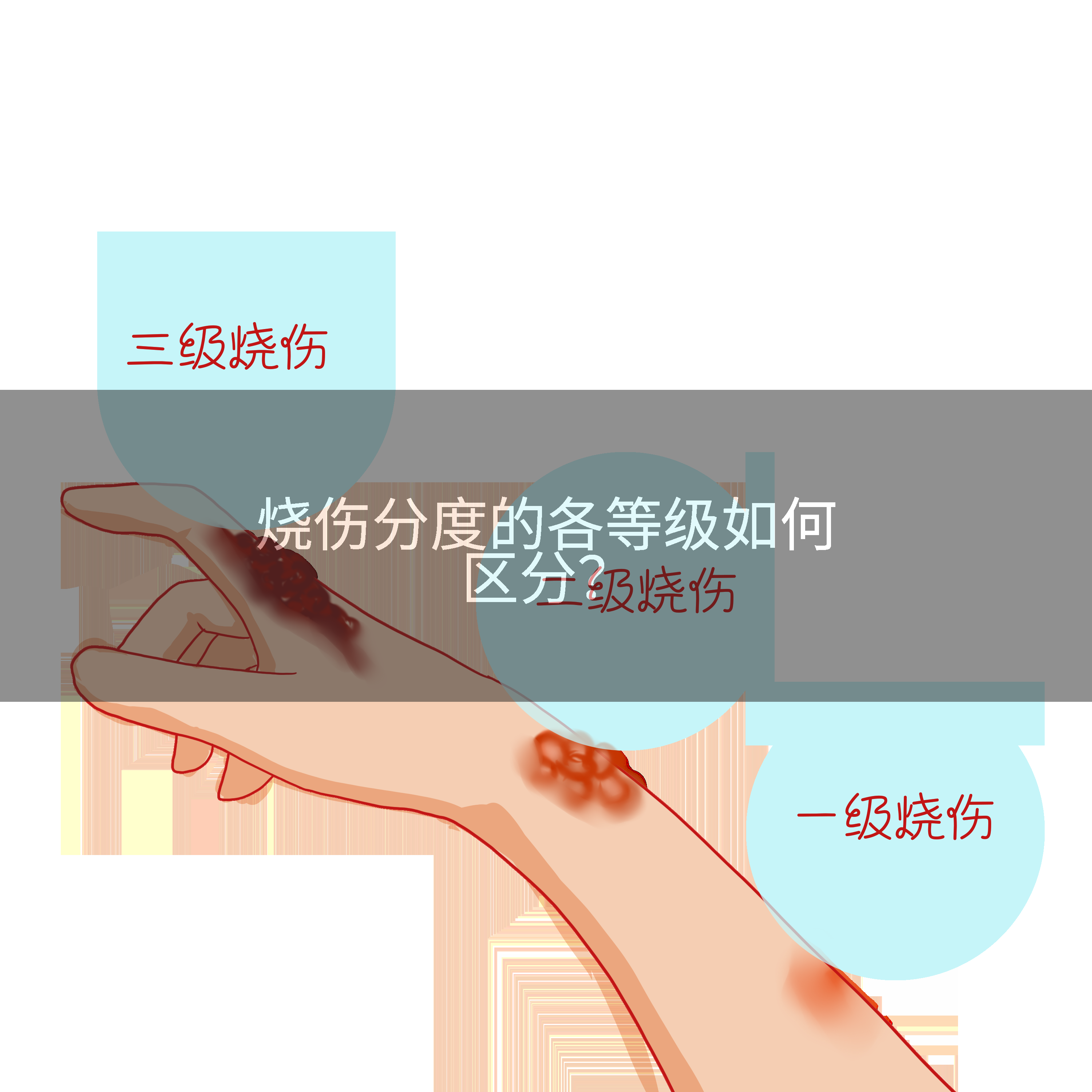 烧伤分度的各等级如何区分？