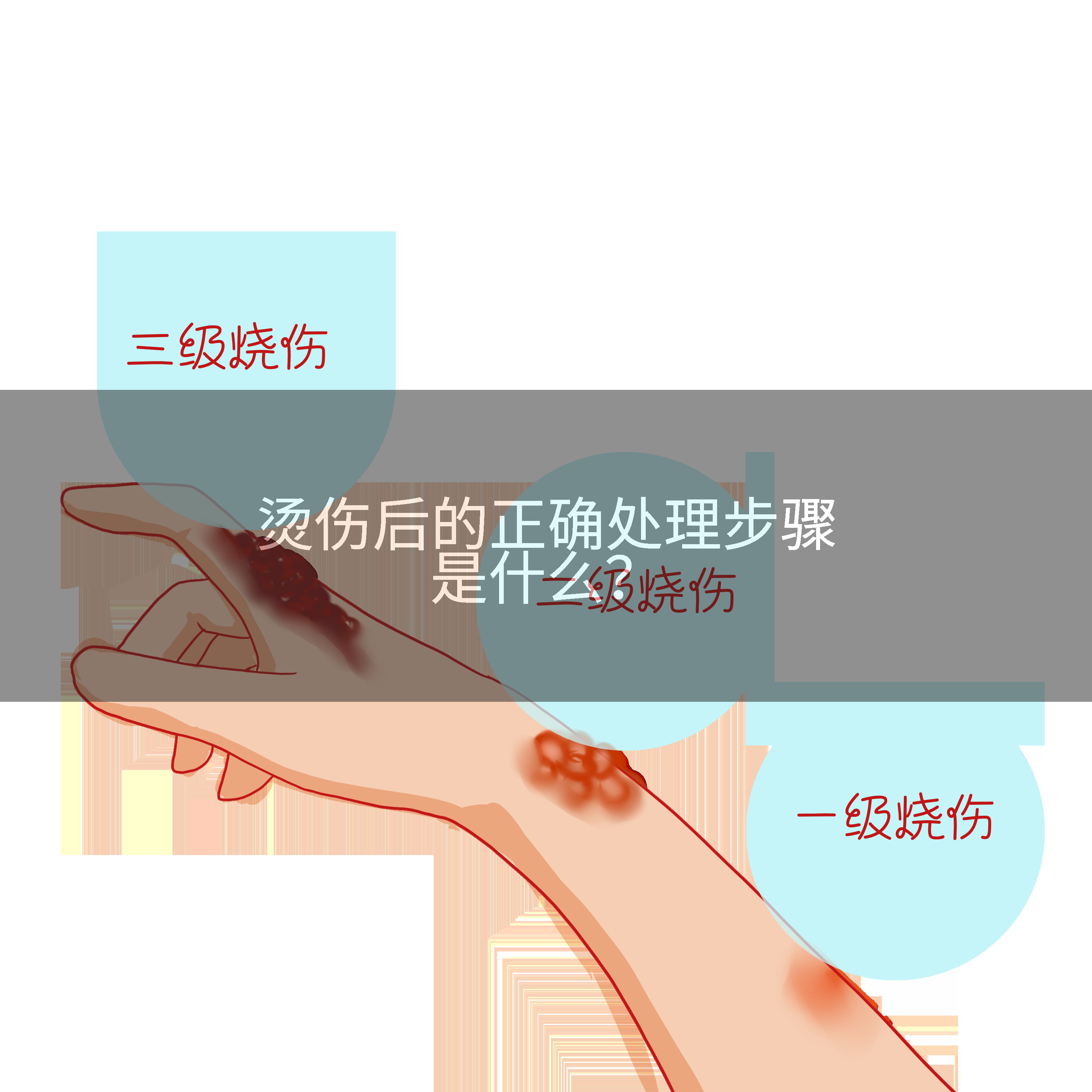 烫伤后的正确处理步骤是什么？