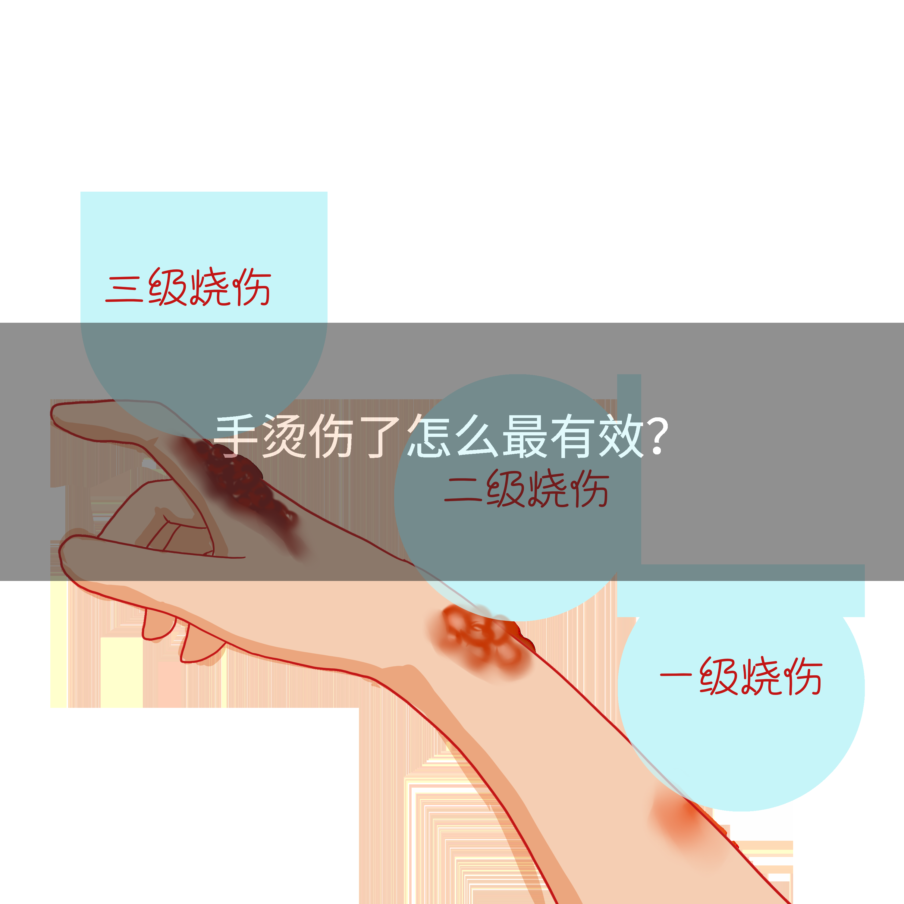 手烫伤了怎么最有效？