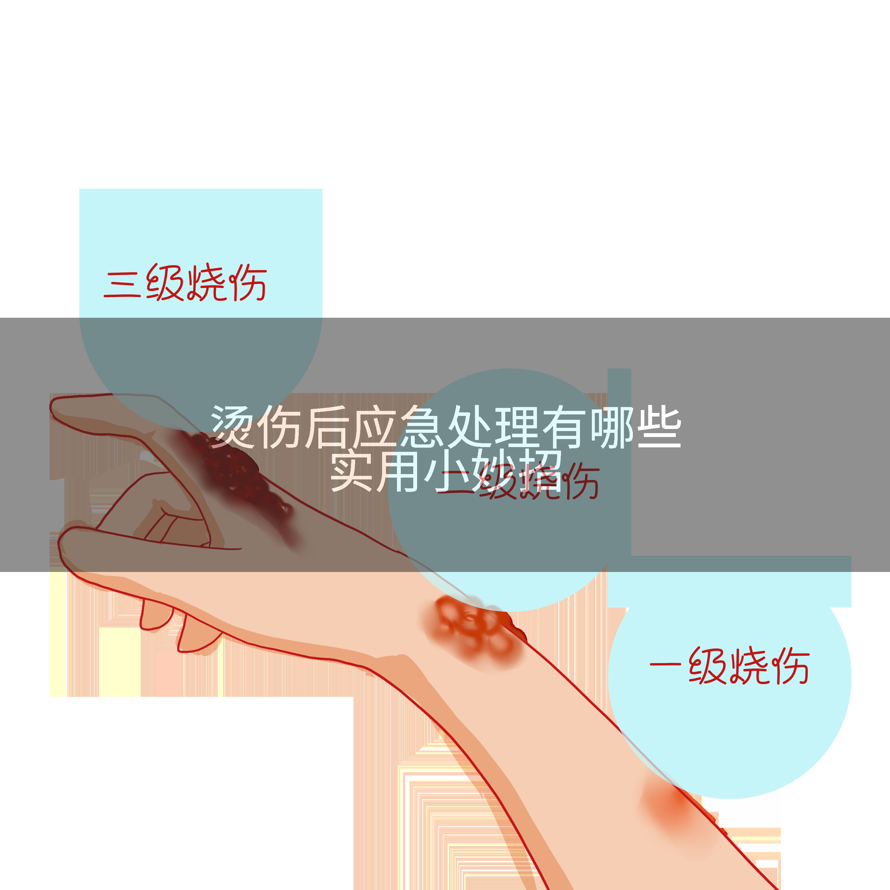 烫伤后应急处理有哪些实用小妙招