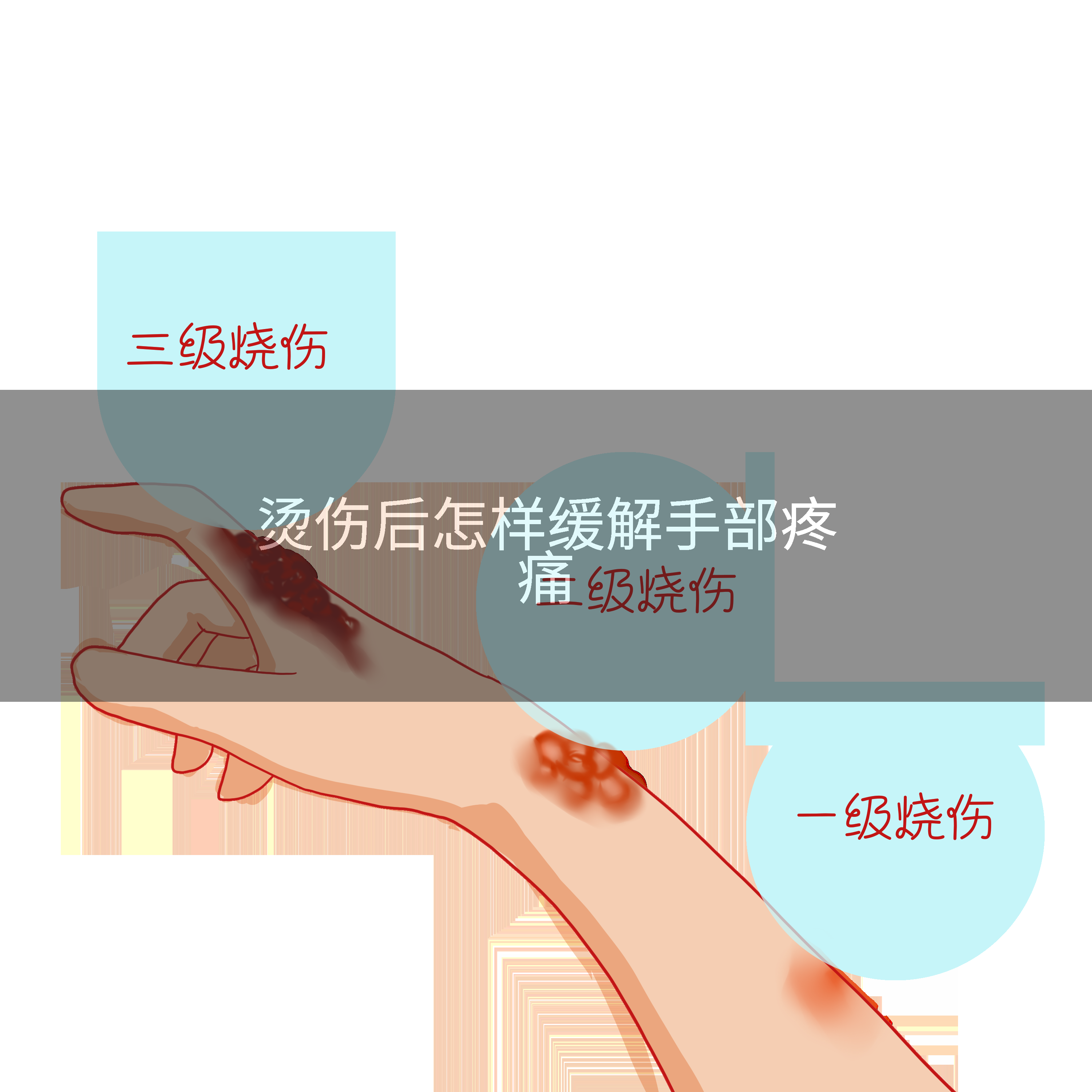 烫伤后怎样缓解手部疼痛