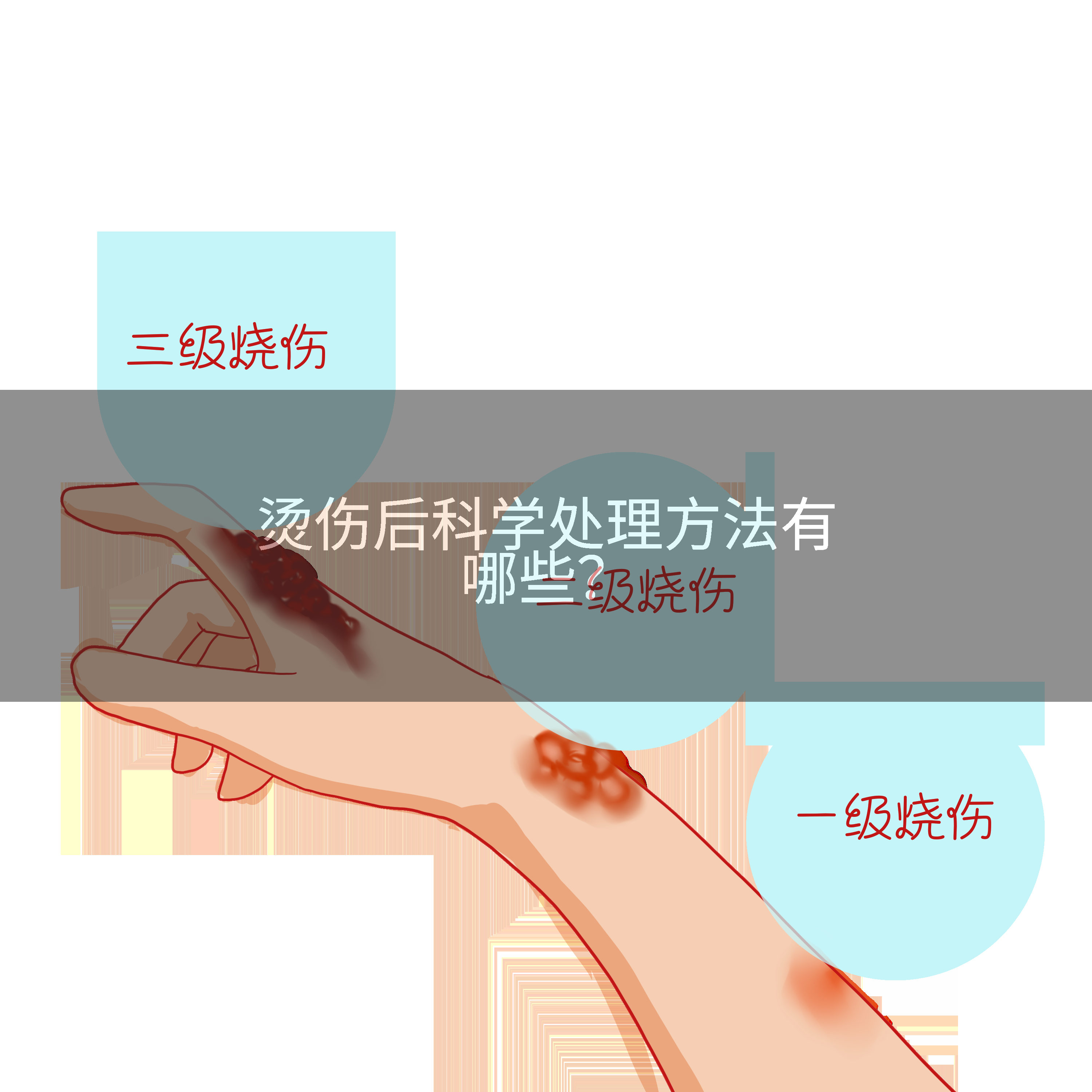 烫伤后科学处理方法有哪些？