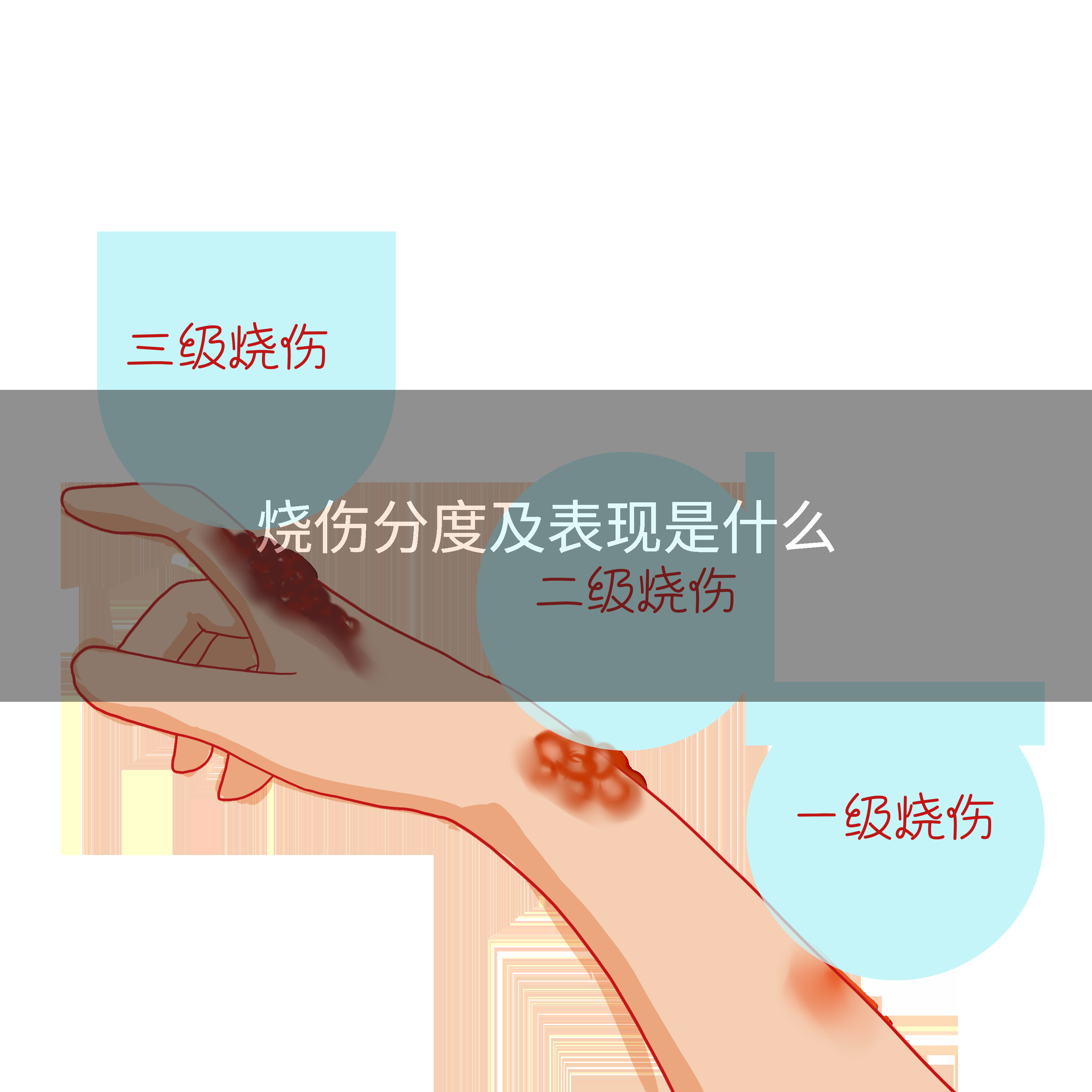 烧伤分度及表现是什么