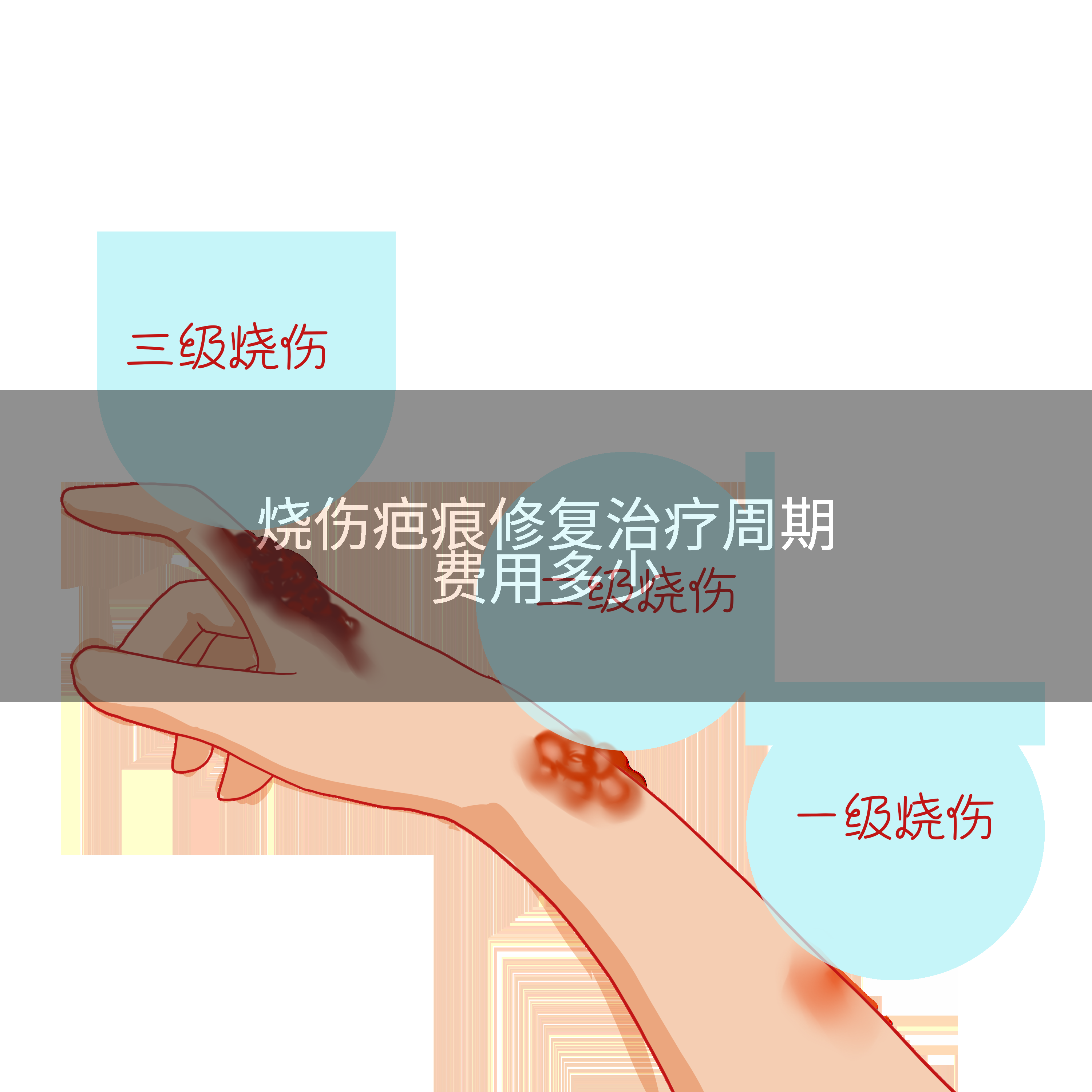 烧伤疤痕修复治疗周期费用多少