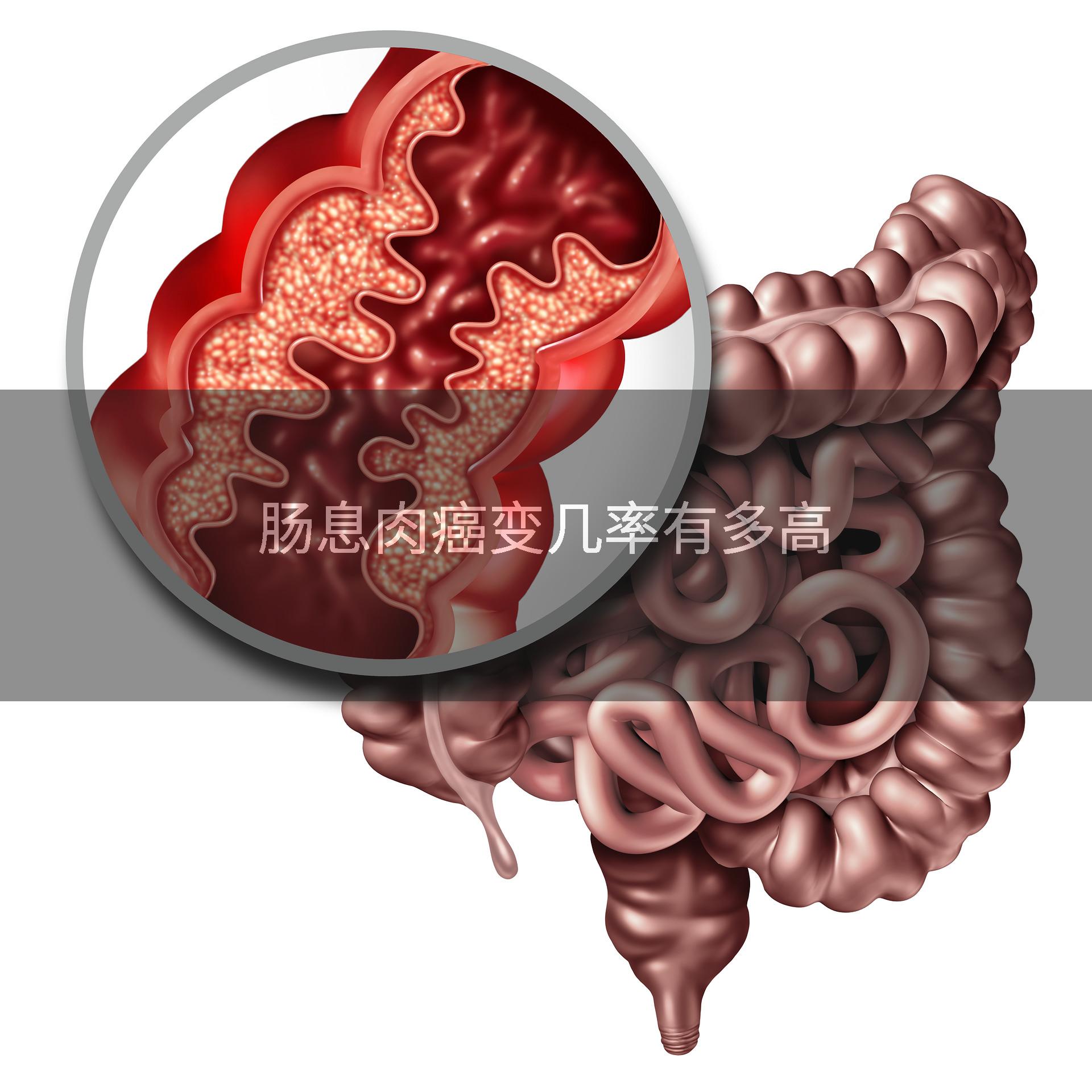 肠息肉癌变几率有多高
