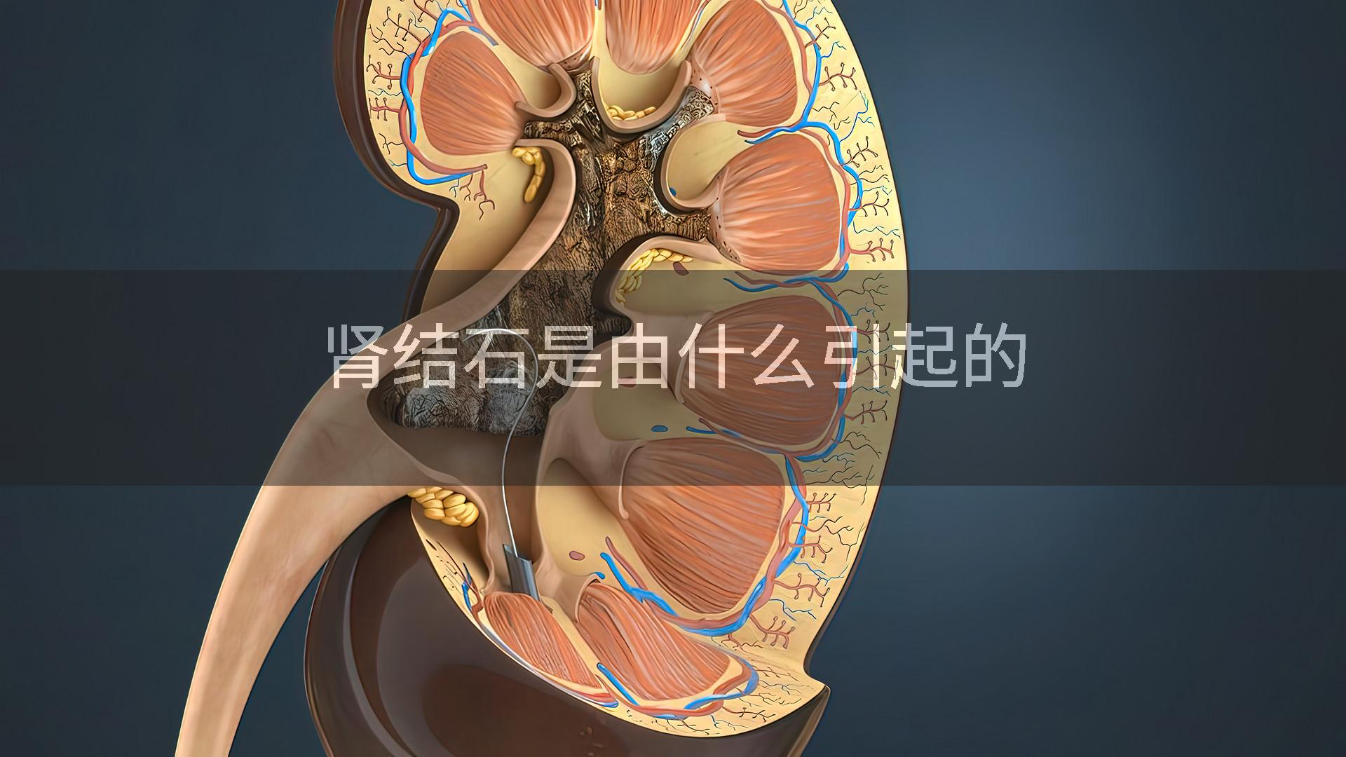 肾结石是由什么引起的