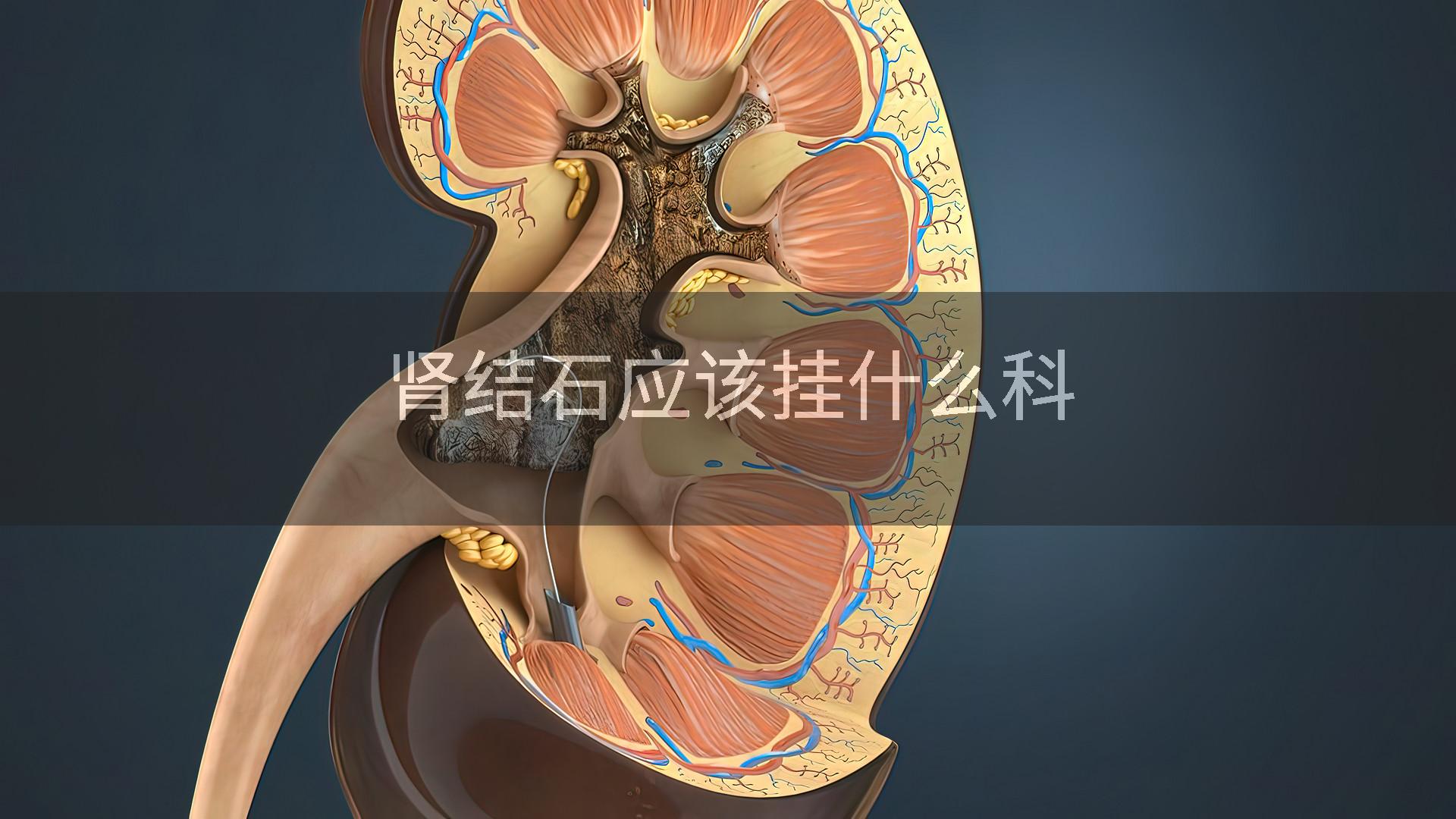 肾结石应该挂什么科