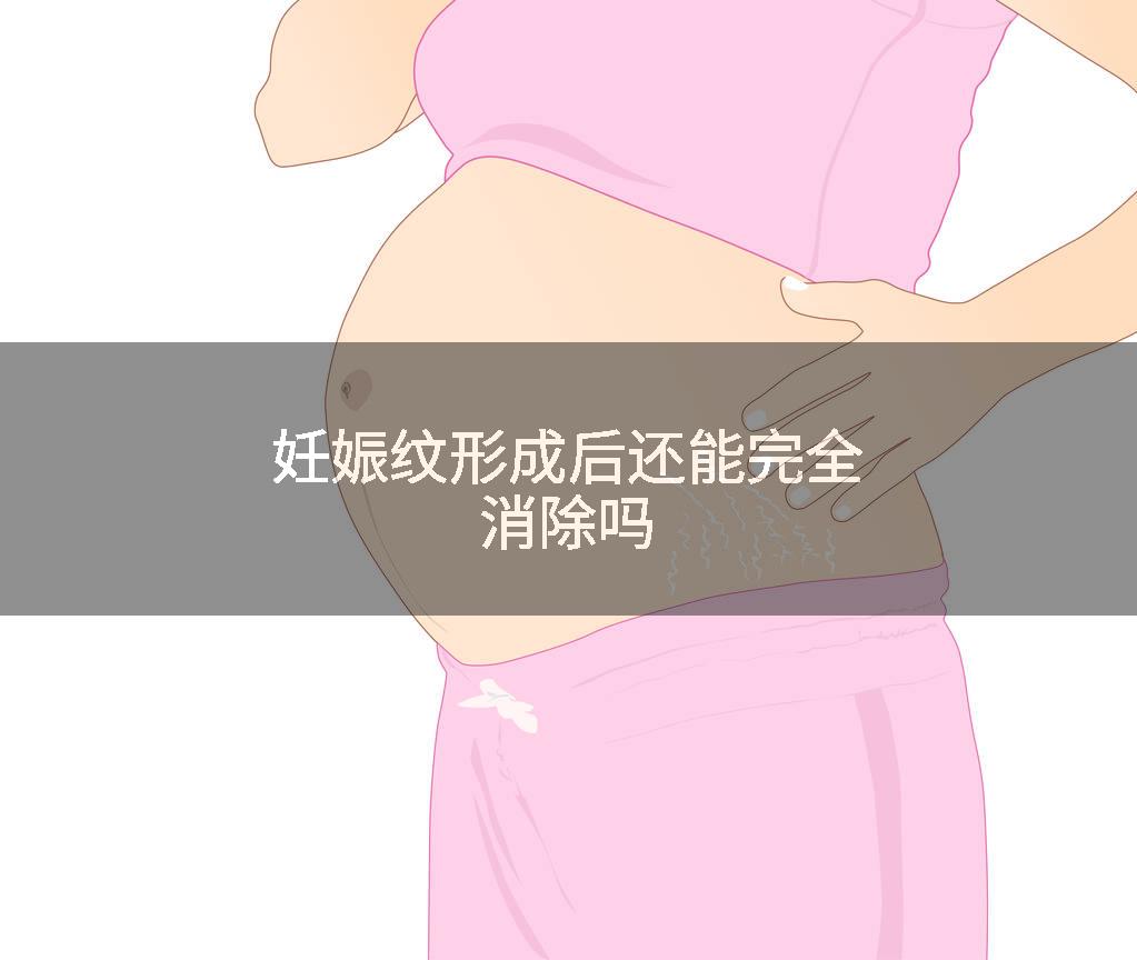妊娠纹形成后还能完全消除吗