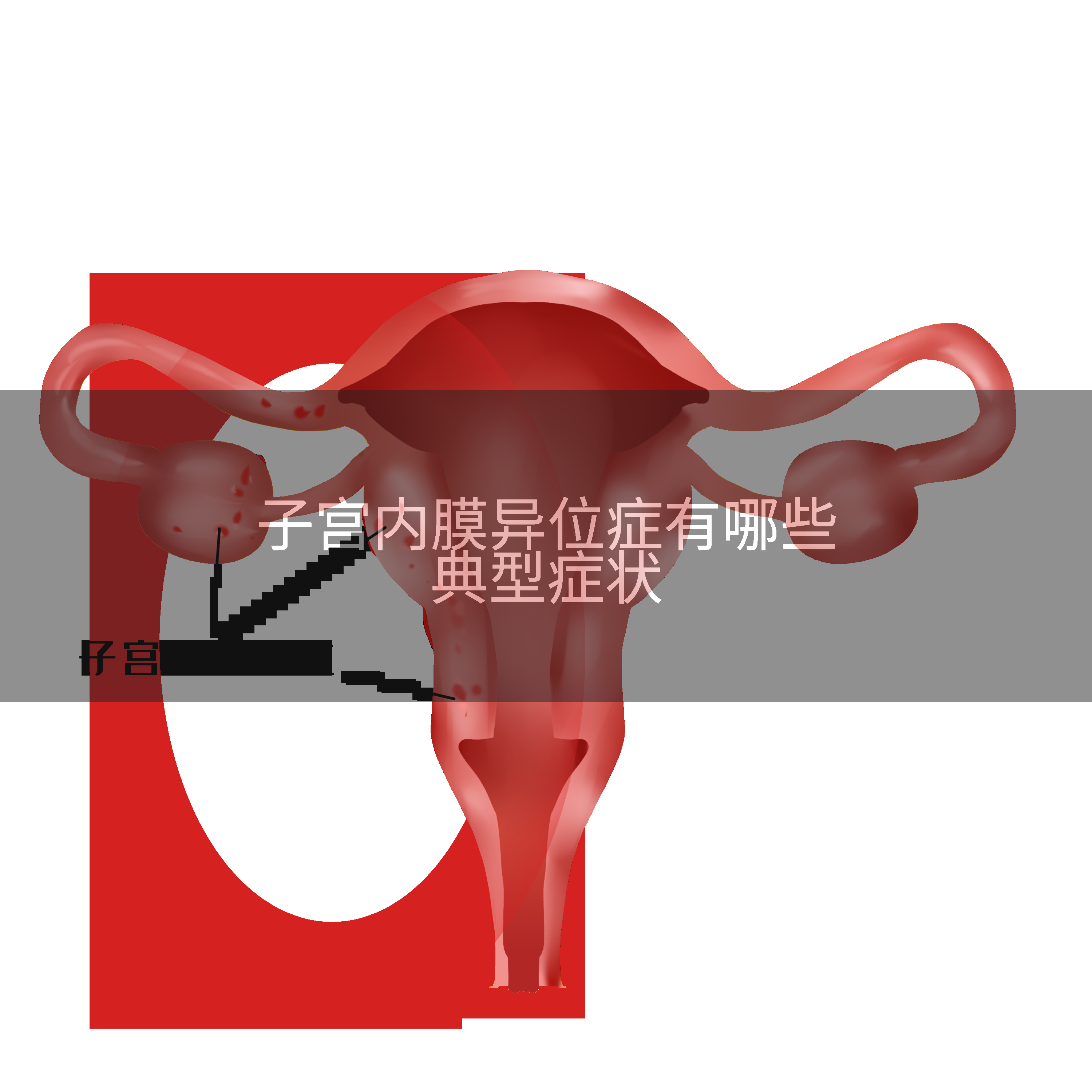 子宫内膜异位症有哪些典型症状