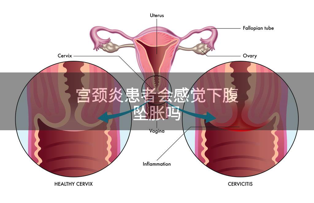 宫颈炎患者会感觉下腹坠胀吗