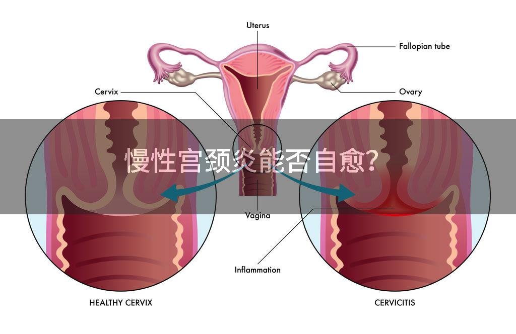 慢性宫颈炎能否自愈?