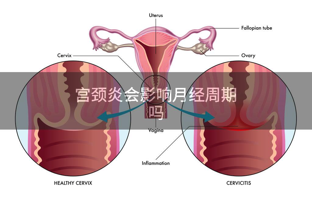 宫颈炎会影响月经周期吗