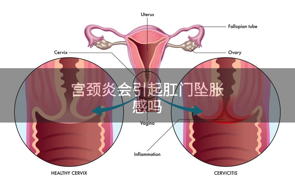 宫颈炎会引起肛门坠胀感吗
