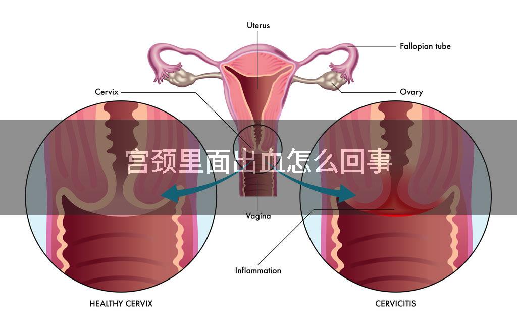 宫颈里面出血怎么回事