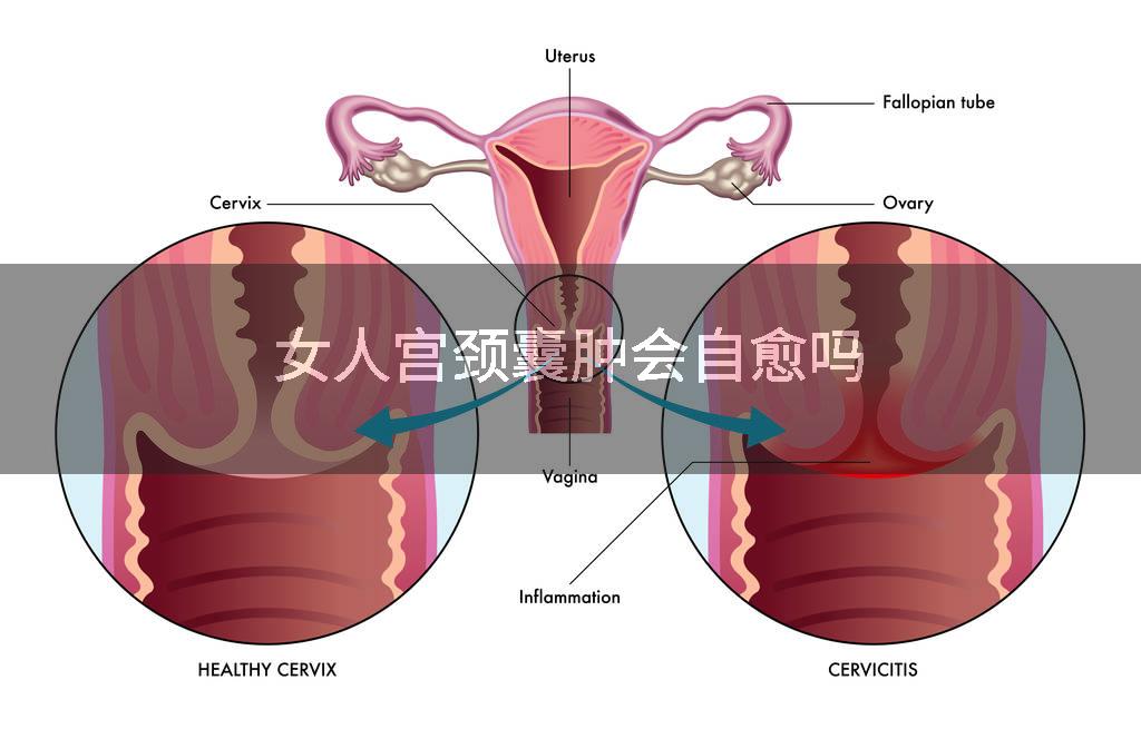 女人宫颈囊肿会自愈吗