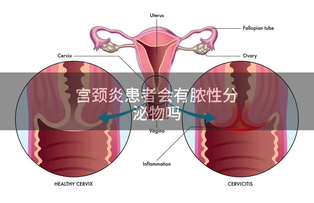 宫颈炎患者会有脓性分泌物吗