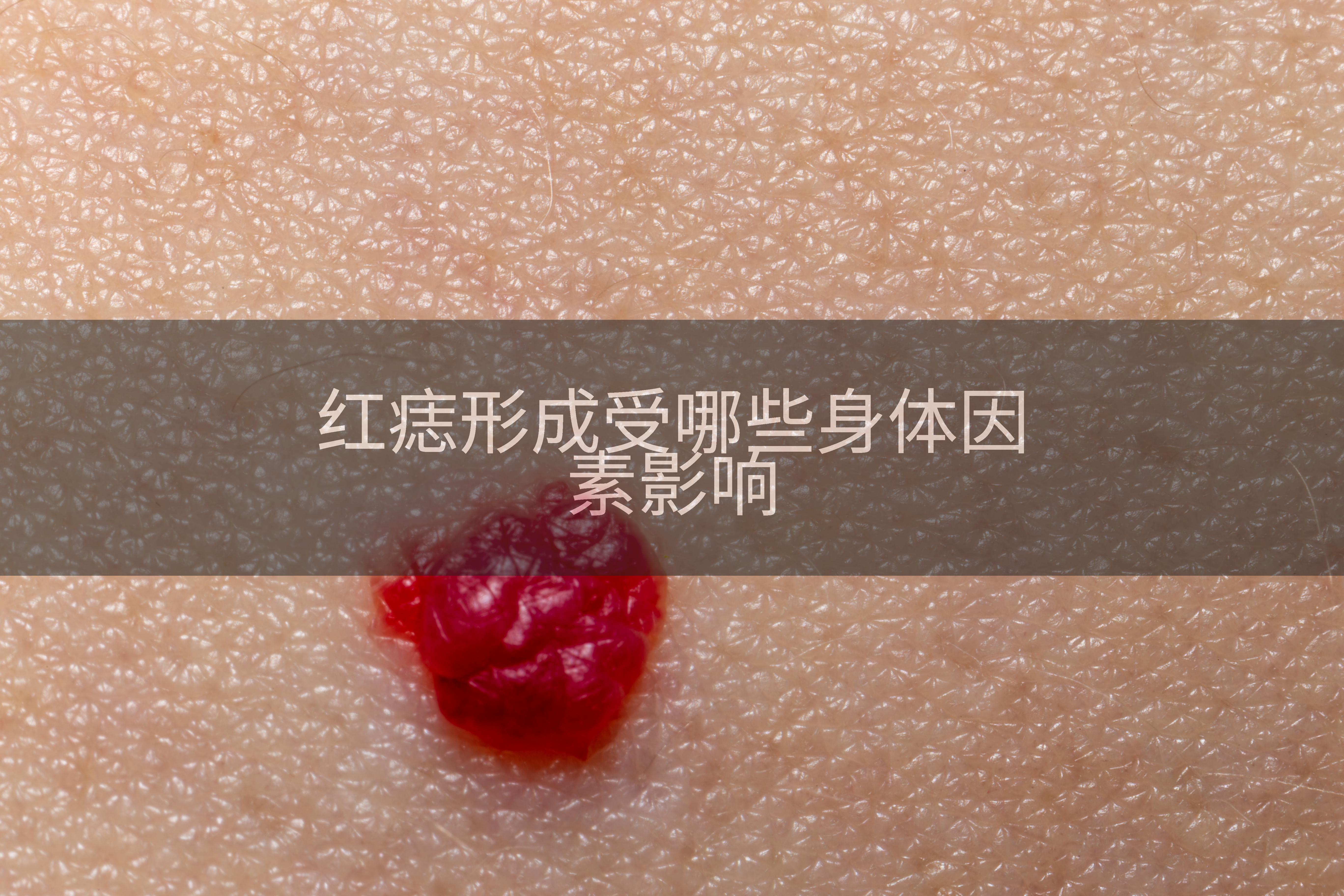 红痣形成受哪些身体因素影响