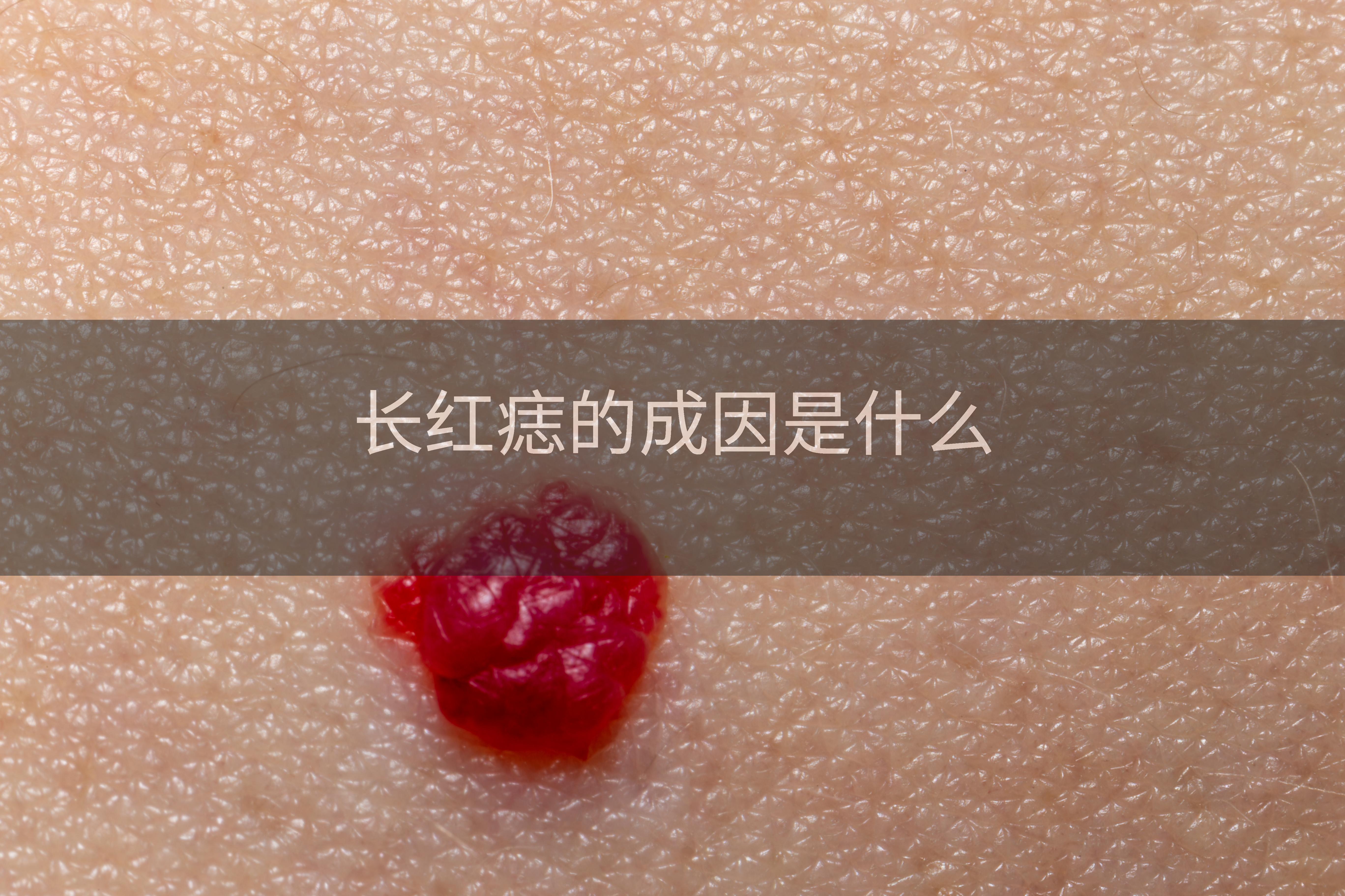 长红痣的成因是什么