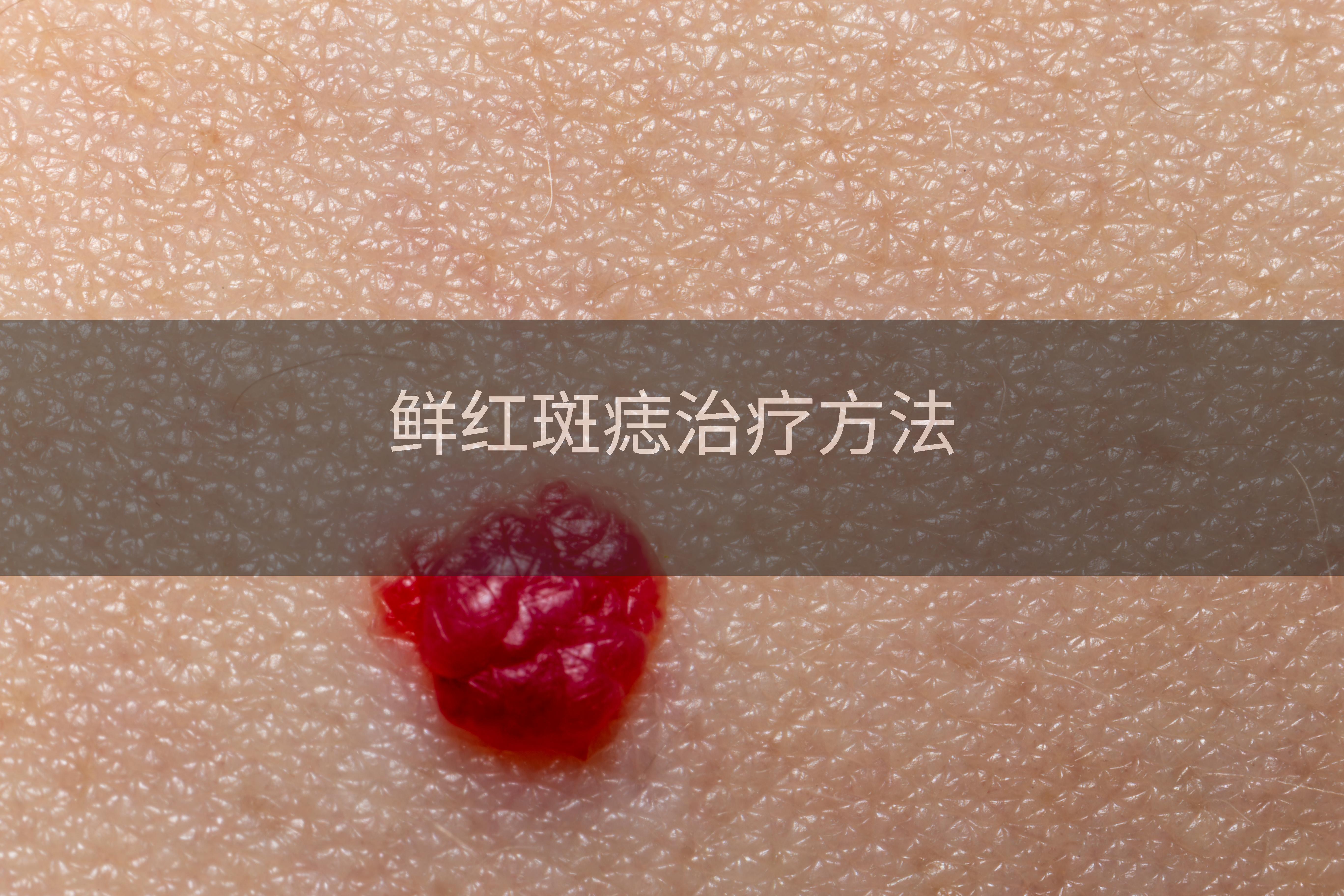 鲜红斑痣治疗方法