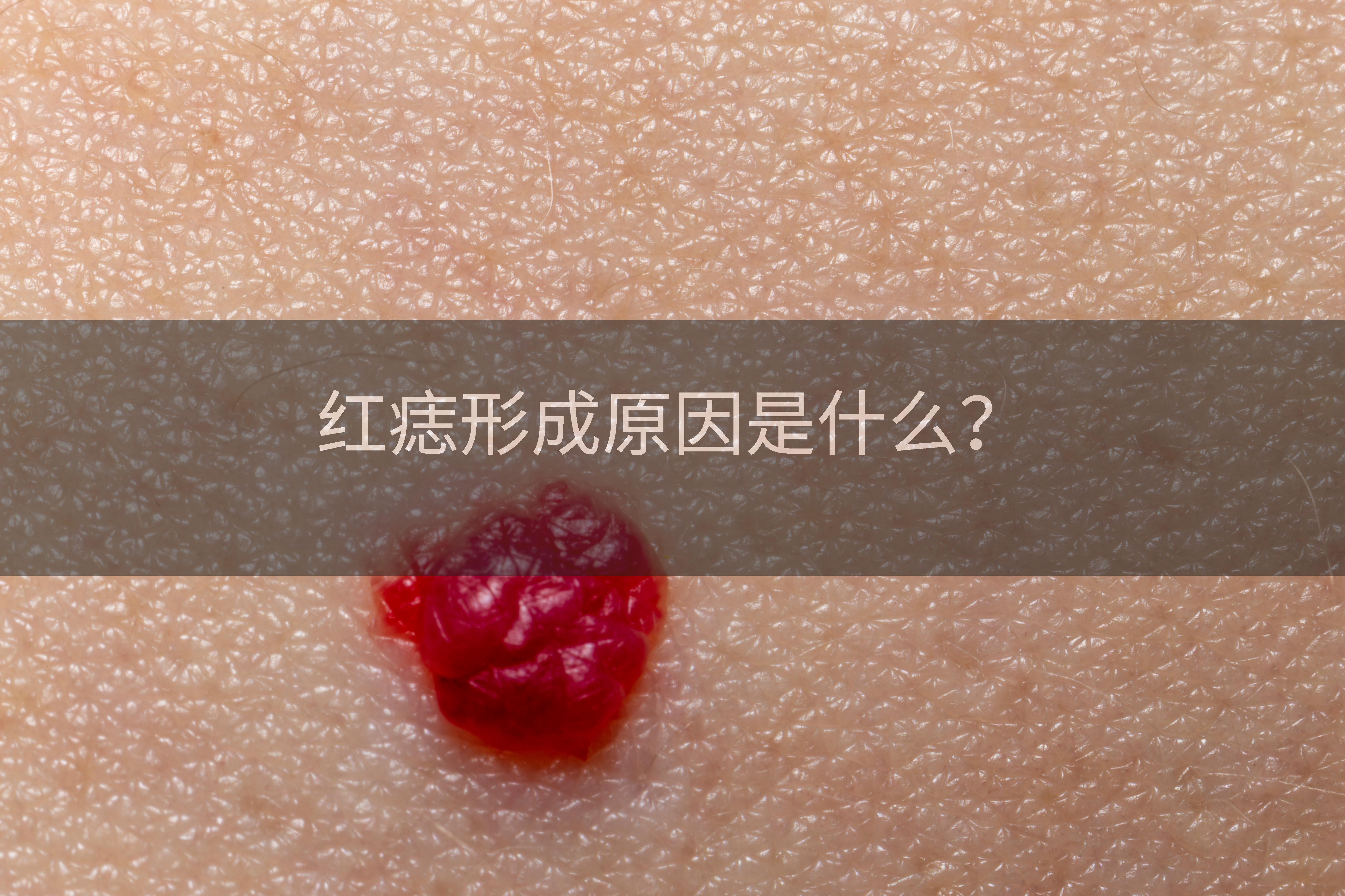 红痣形成原因是什么？
