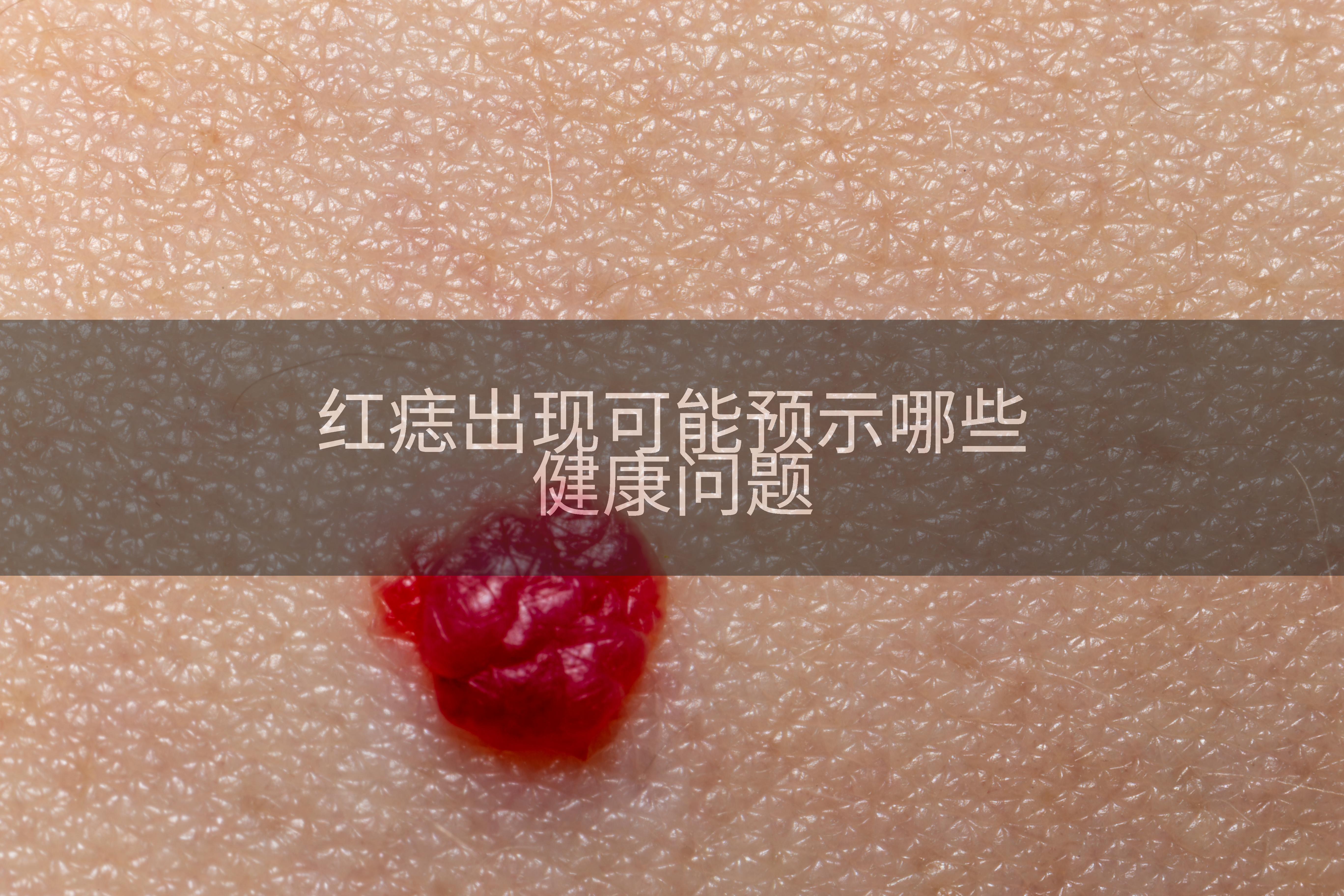 红痣出现可能预示哪些健康问题