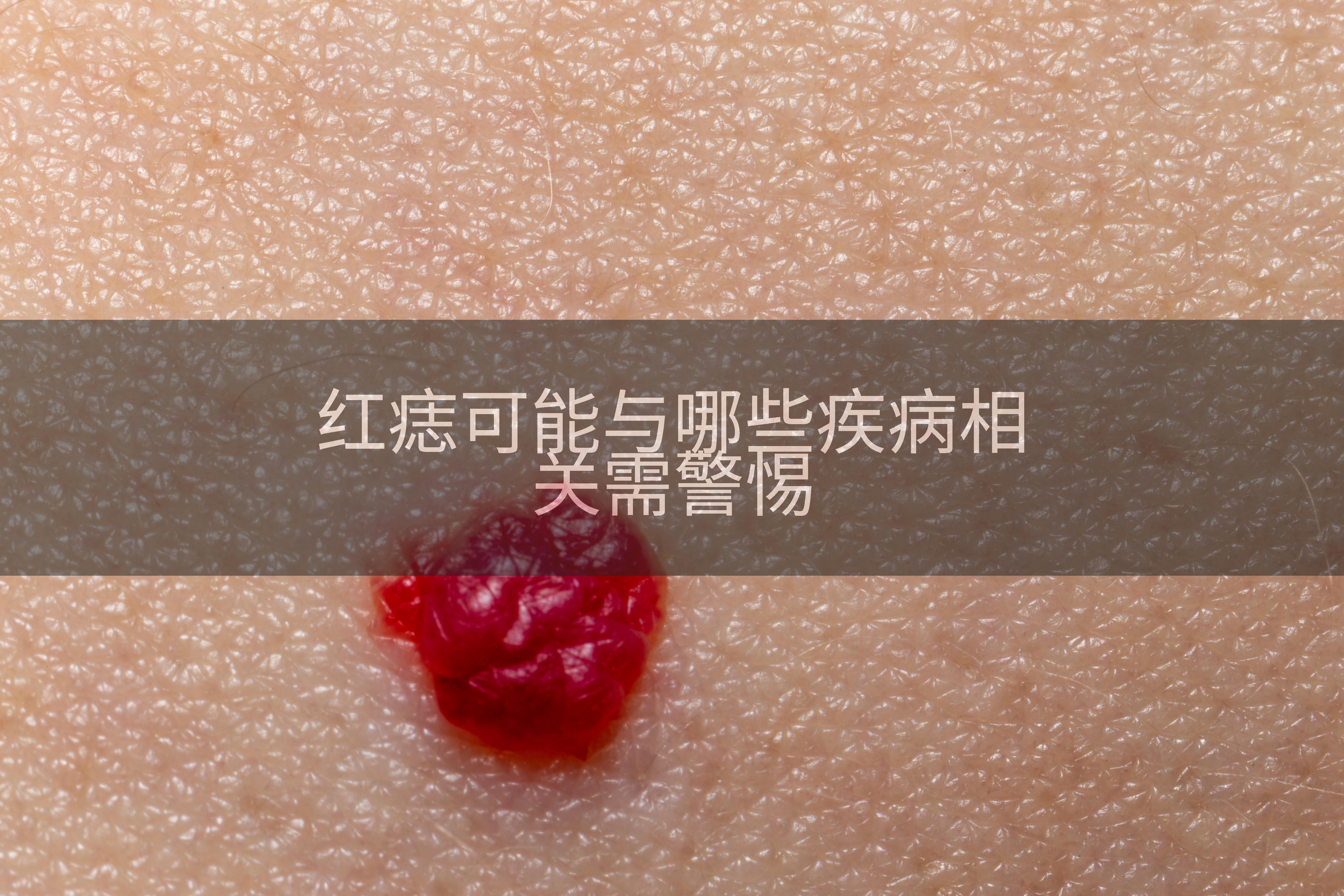 红痣可能与哪些疾病相关需警惕