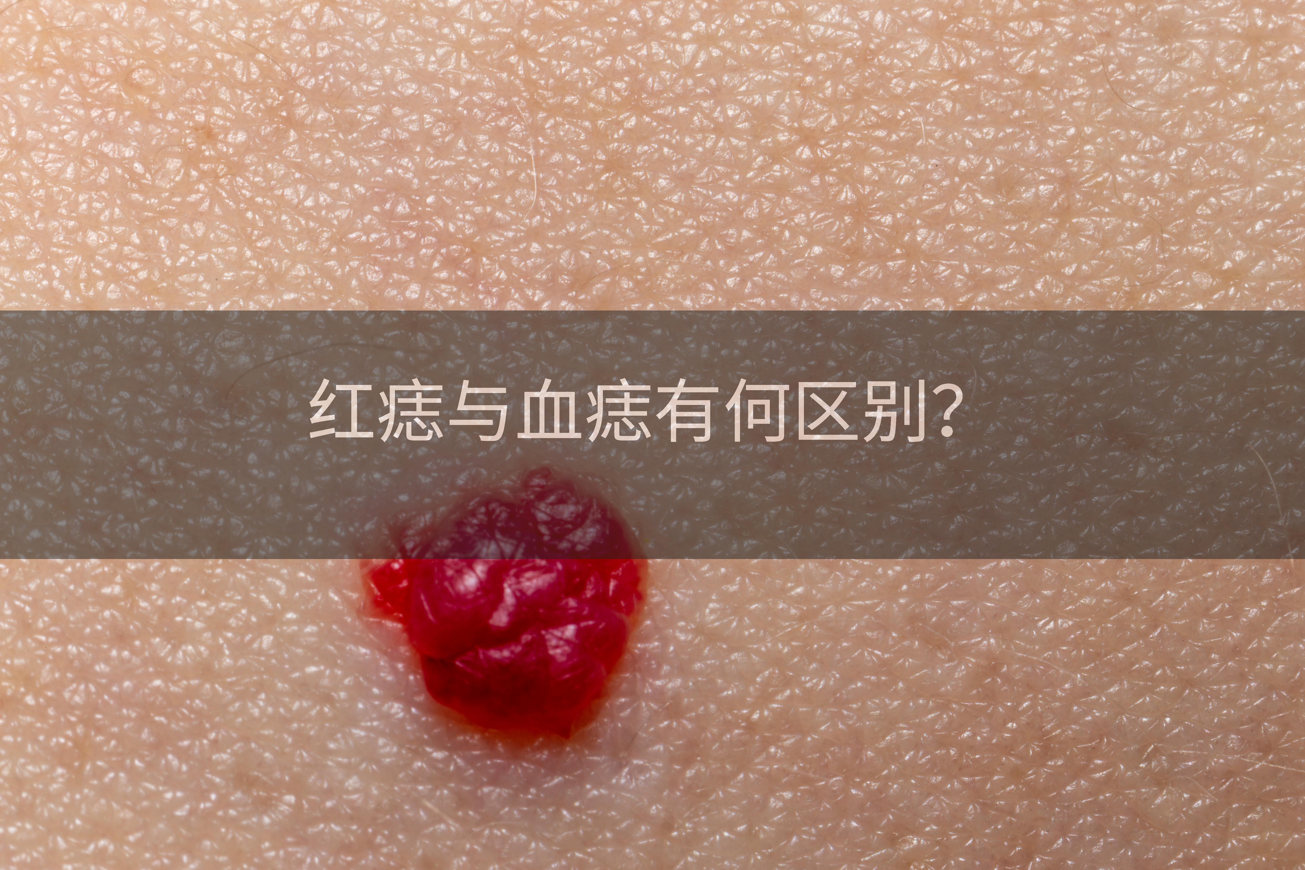 红痣与血痣有何区别？