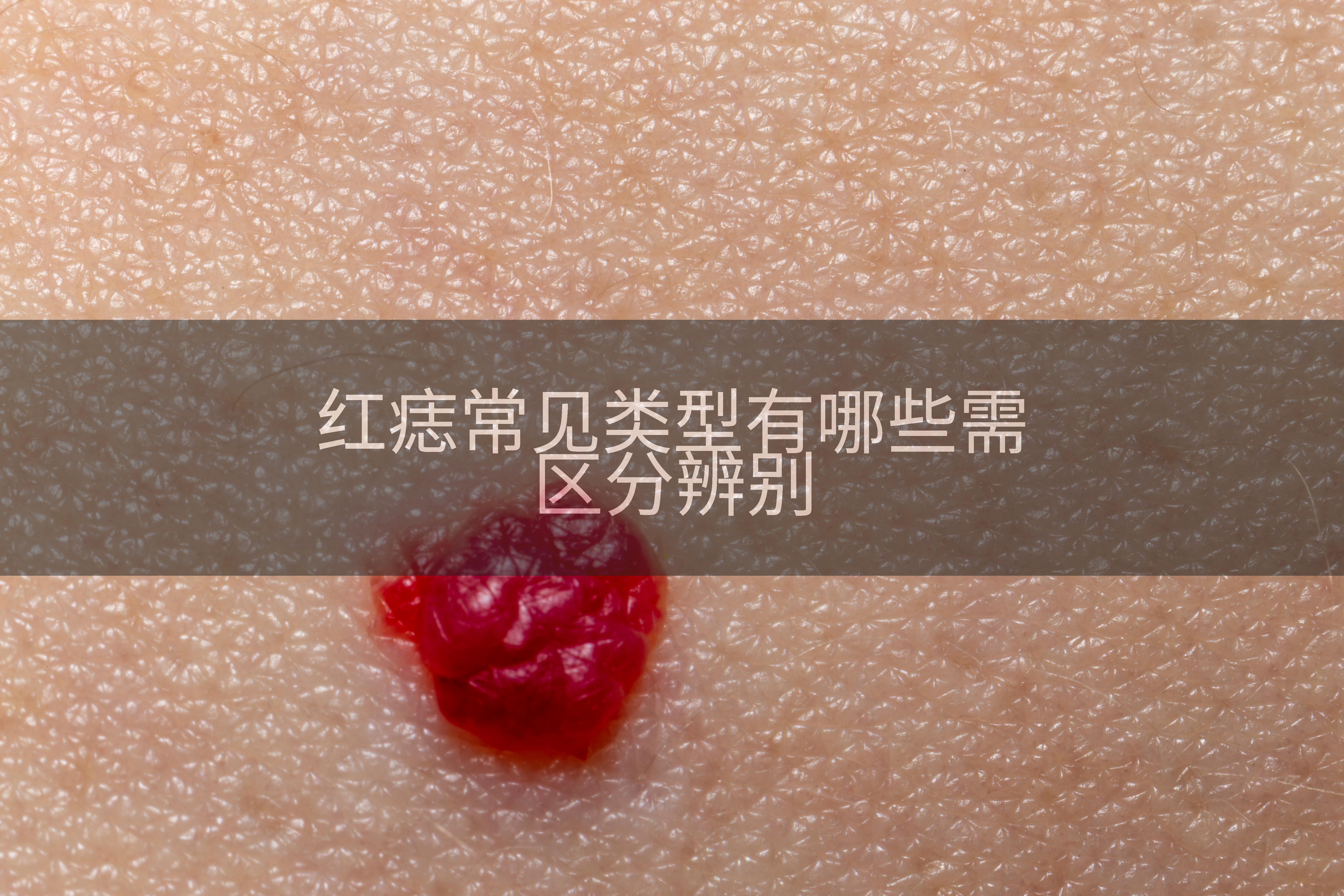 红痣常见类型有哪些需区分辨别