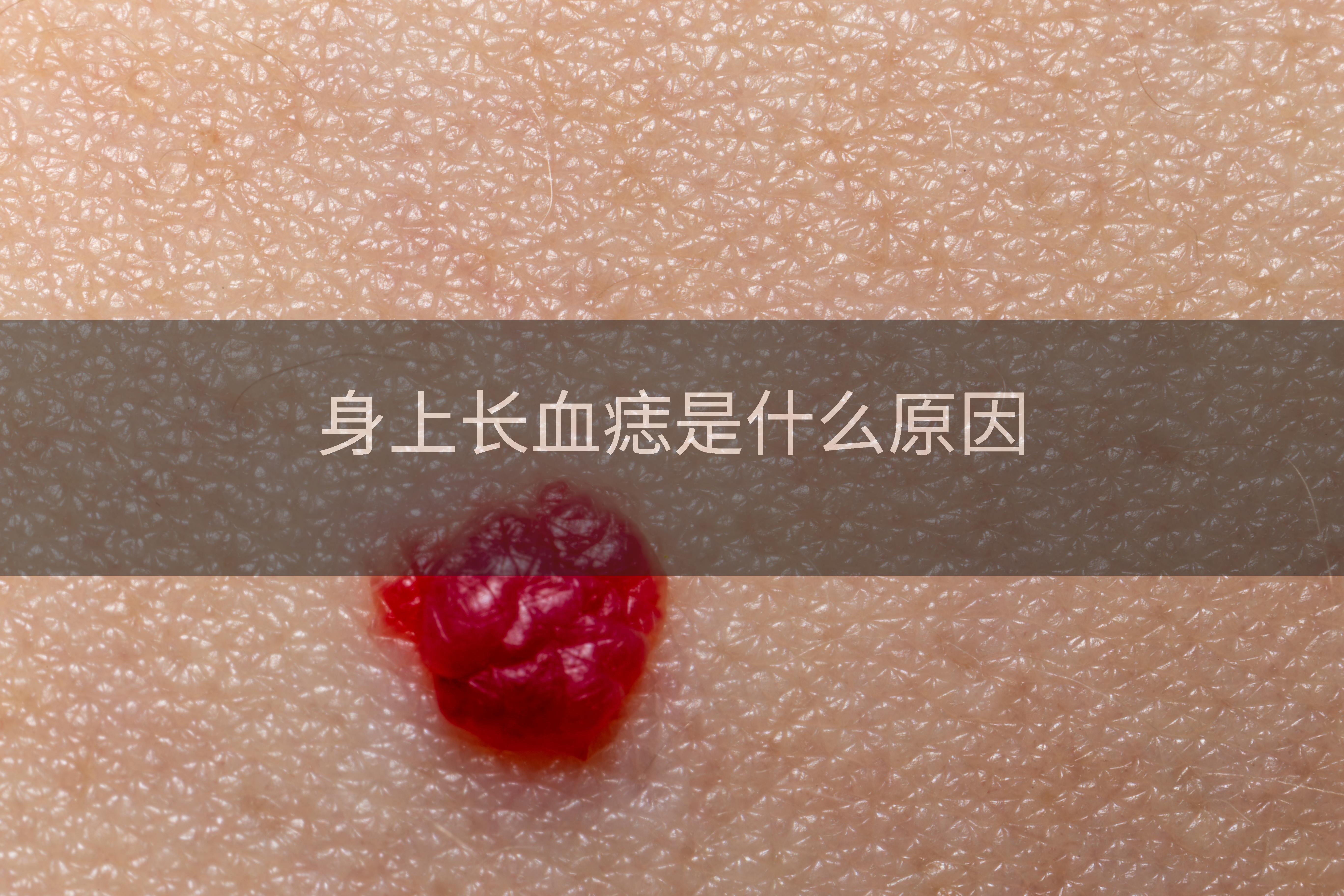 身上长血痣是什么原因