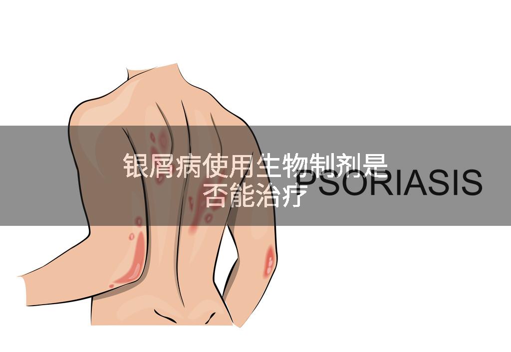 银屑病使用生物制剂是否能治疗