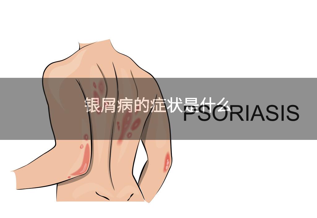 银屑病的症状是什么