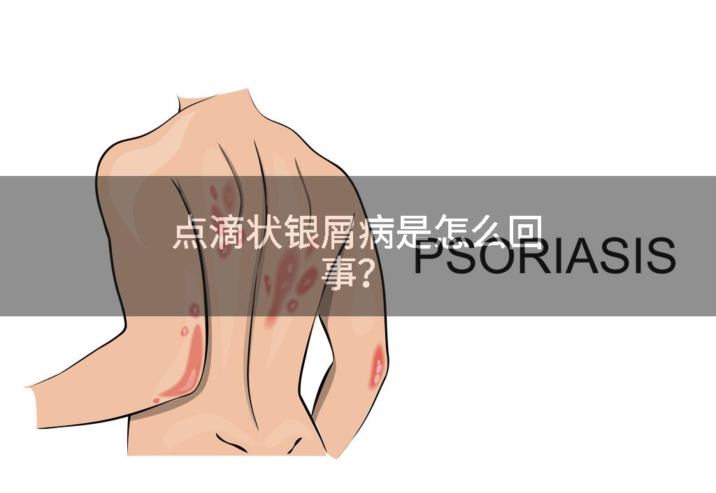点滴状银屑病是怎么回事？