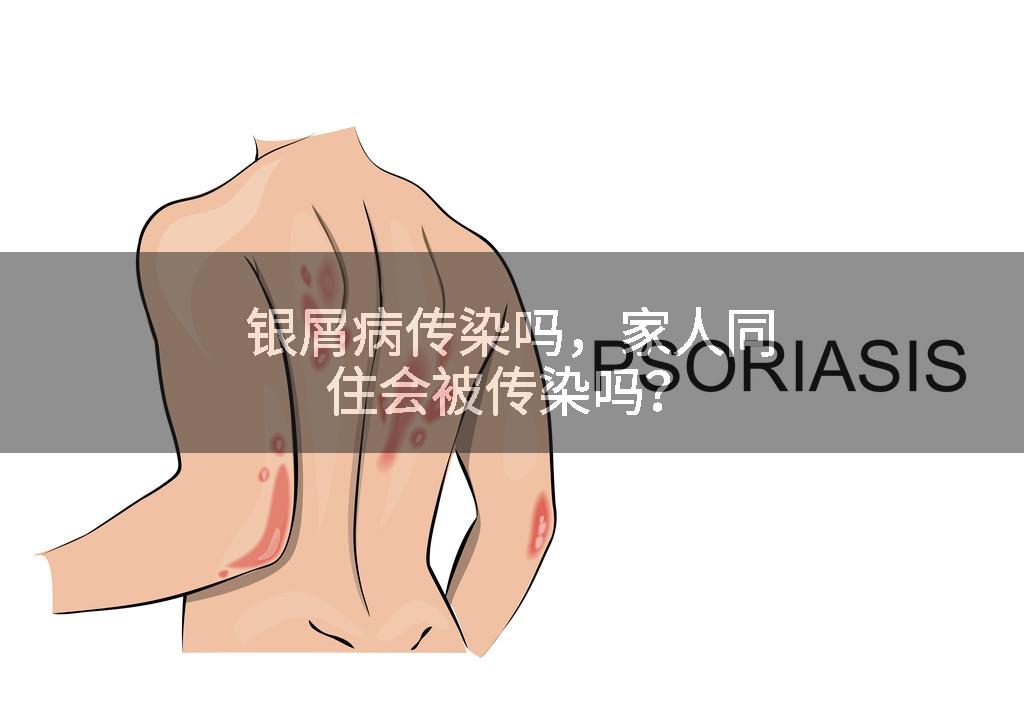 银屑病传染吗，家人同住会被传染吗？