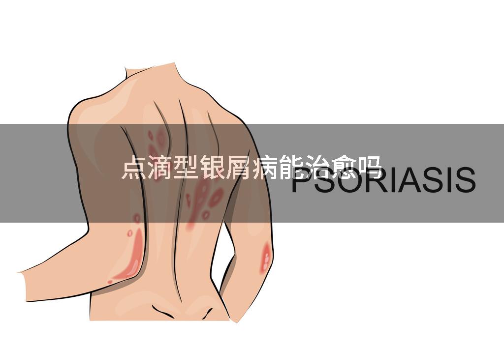 点滴型银屑病能治愈吗