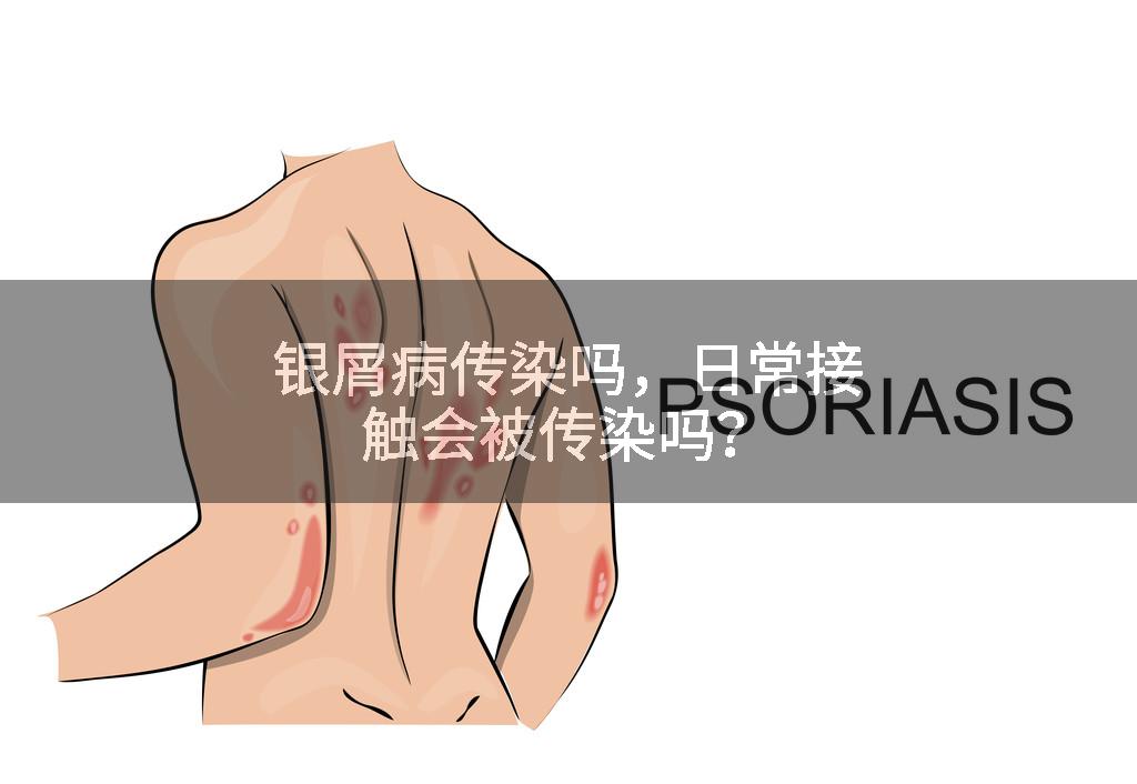银屑病传染吗，日常接触会被传染吗？