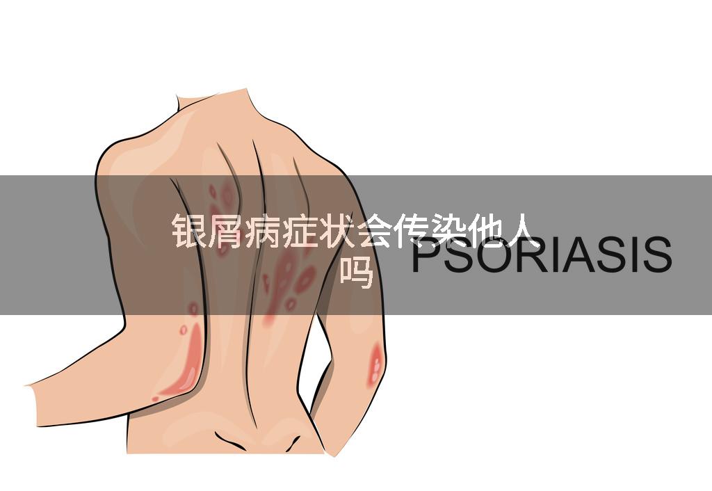 银屑病症状会传染他人吗