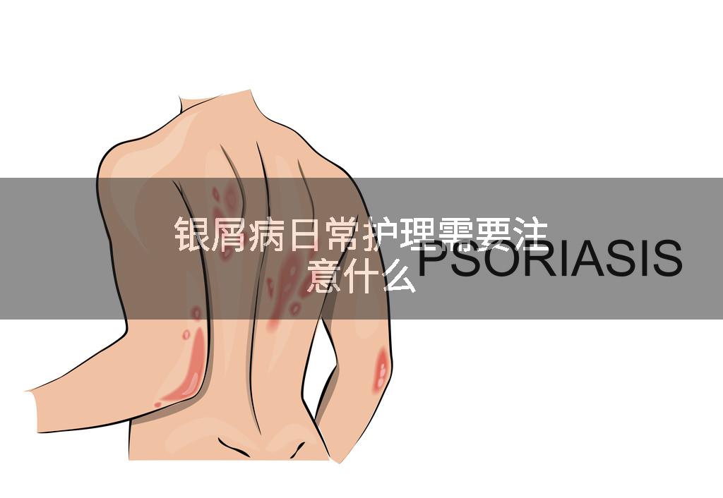 银屑病日常护理需要注意什么