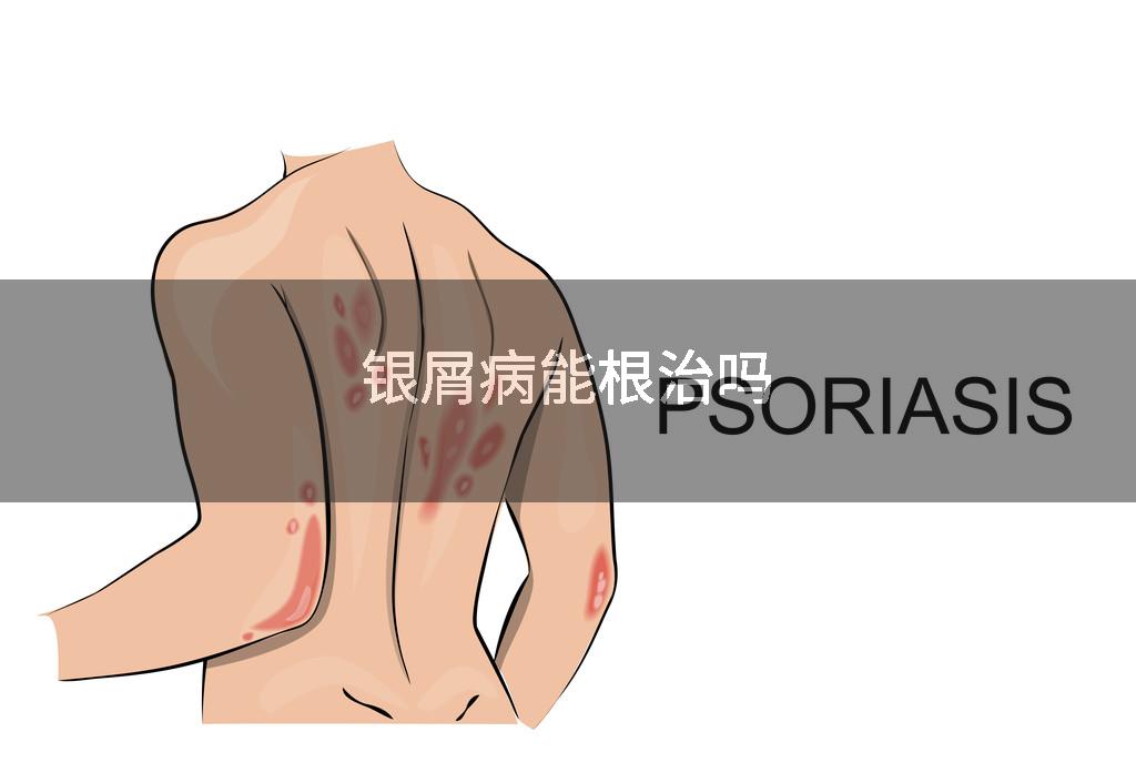 银屑病能根治吗
