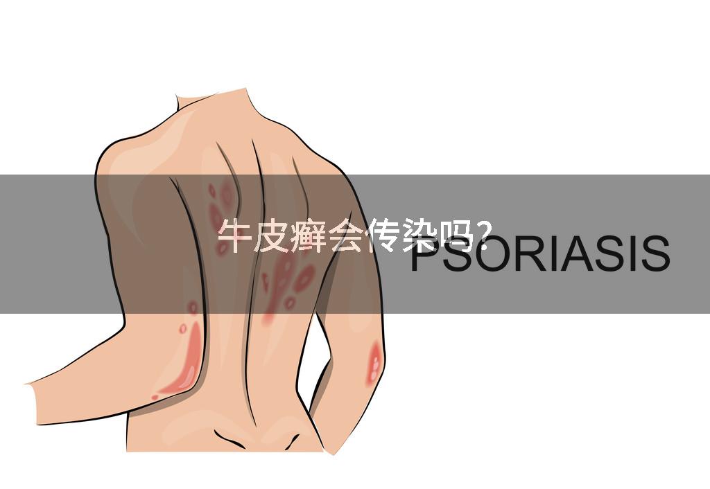 牛皮癣会传染吗?