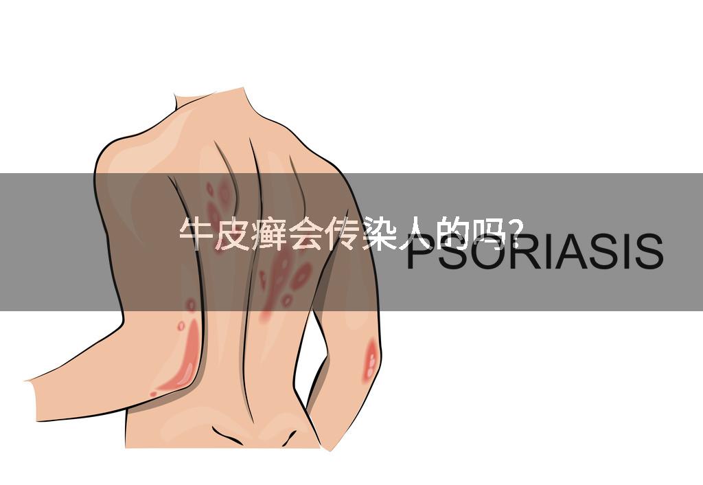 牛皮癣会传染人的吗?