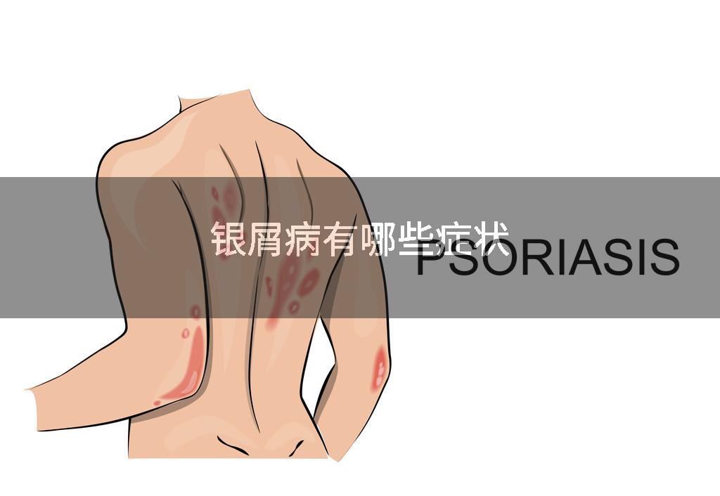 银屑病有哪些症状