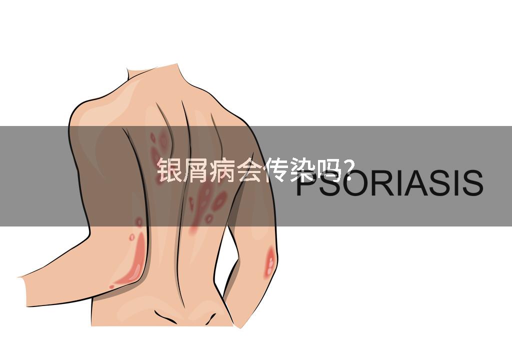 银屑病会传染吗?