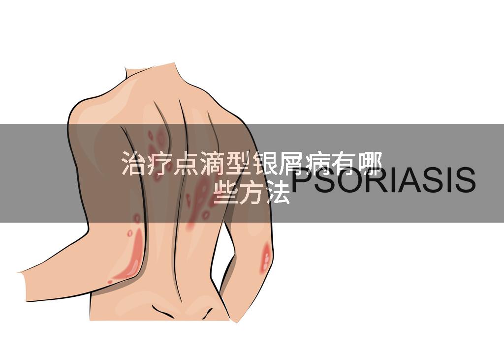 治疗点滴型银屑病有哪些方法